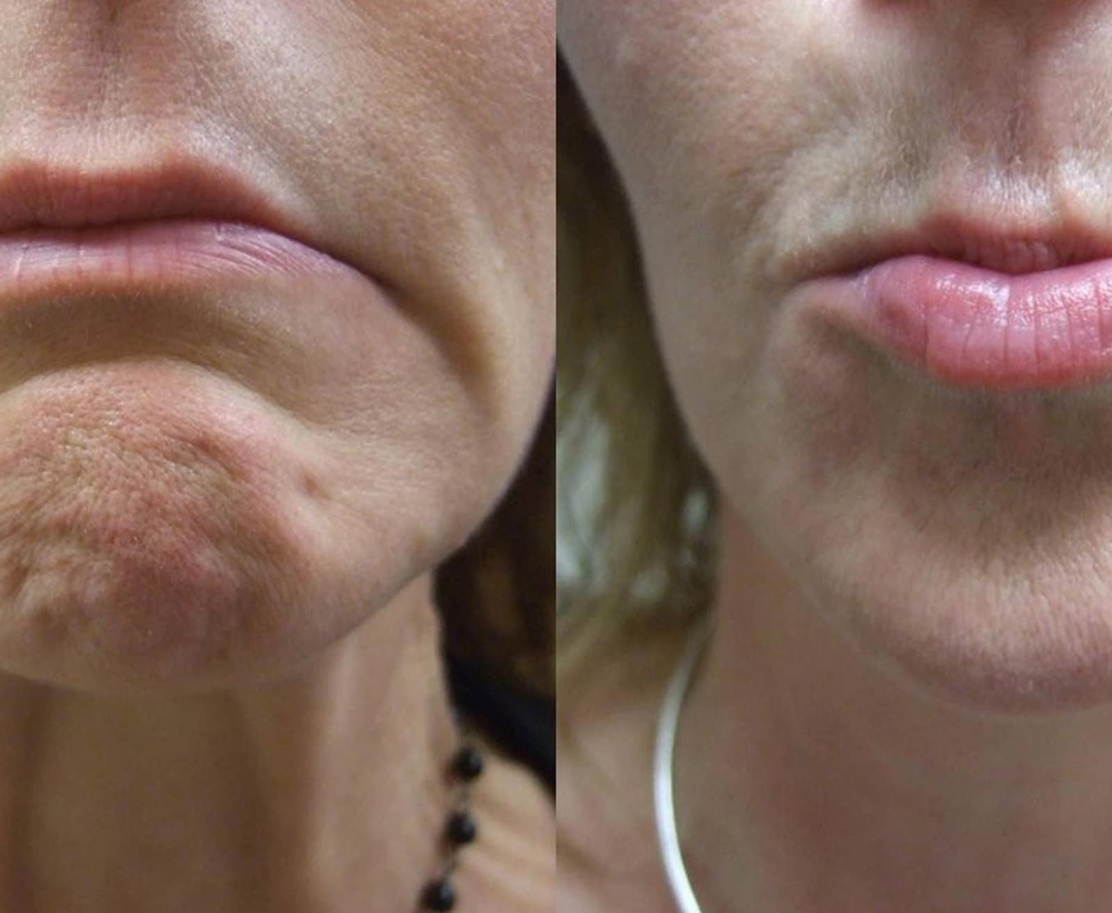 Patients Choose Wymore Laser