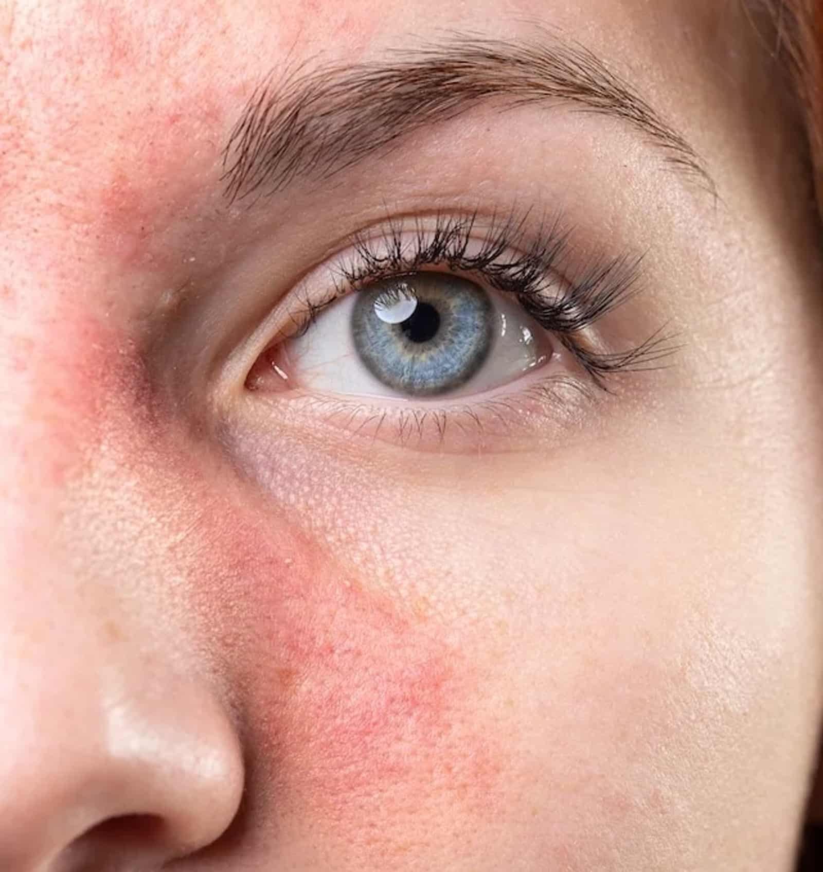 Persistent facial redness