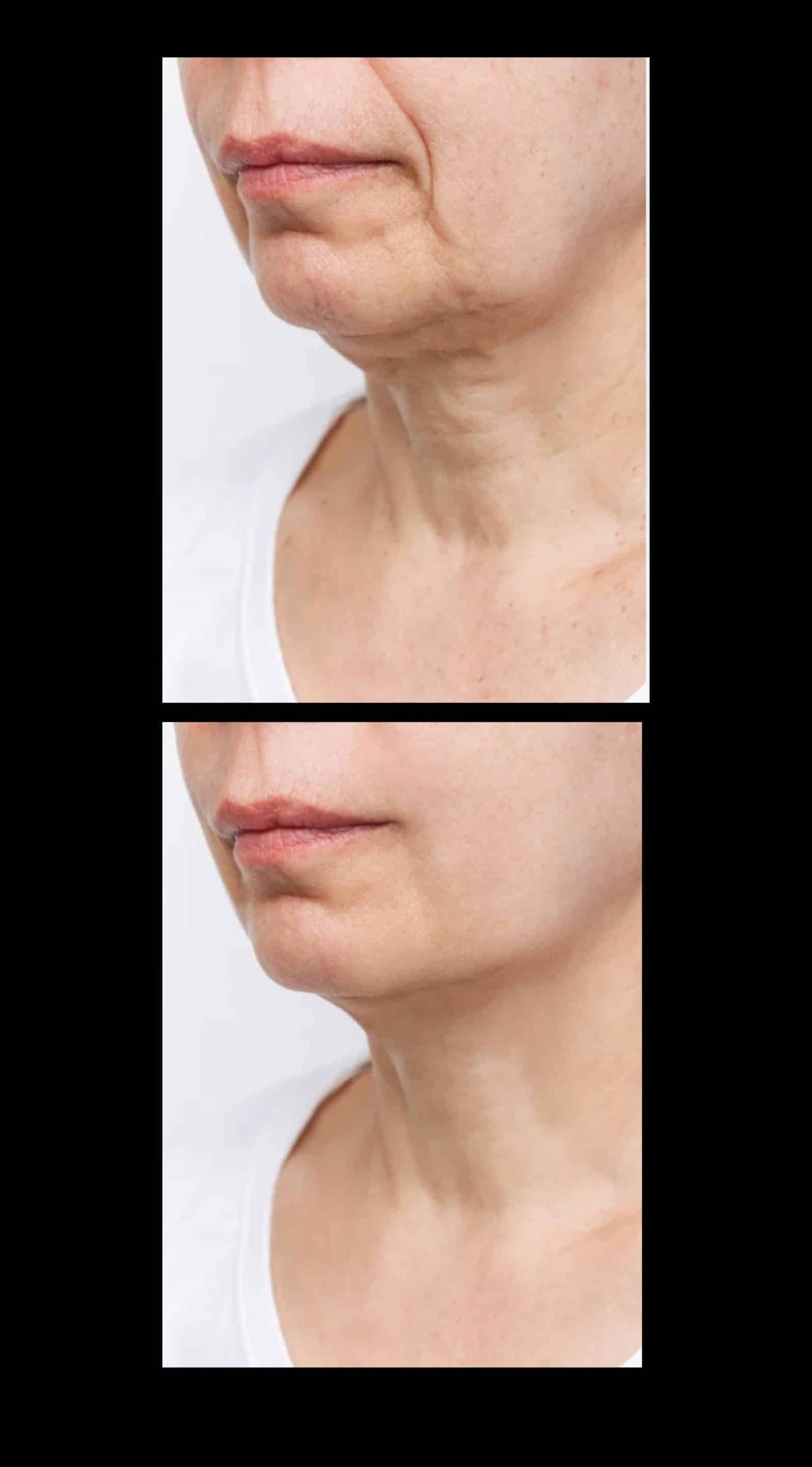 Platysmal Neck Bands