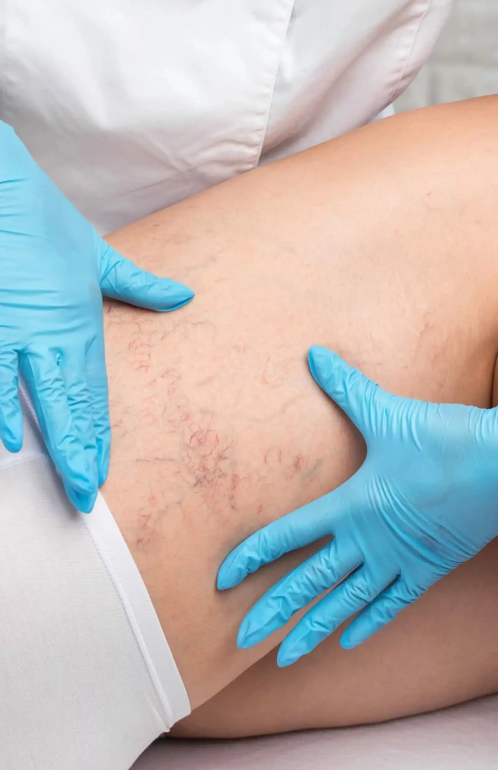 Preparing for Your Sclerotherapy Session Preparing for Your Sclerotherapy Session