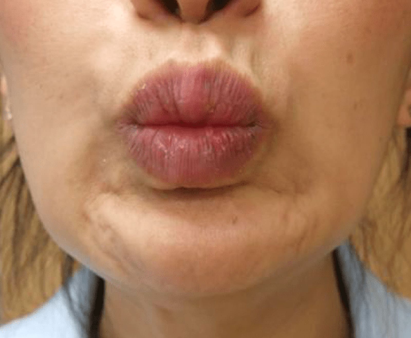 Questions About Dysport