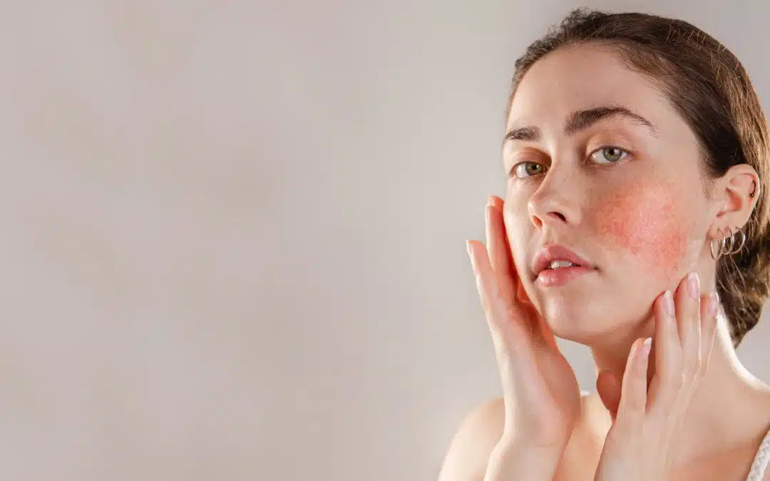 Effective Rosacea Treatment in Winter Park – Clear, Healthy, Radiant Skin