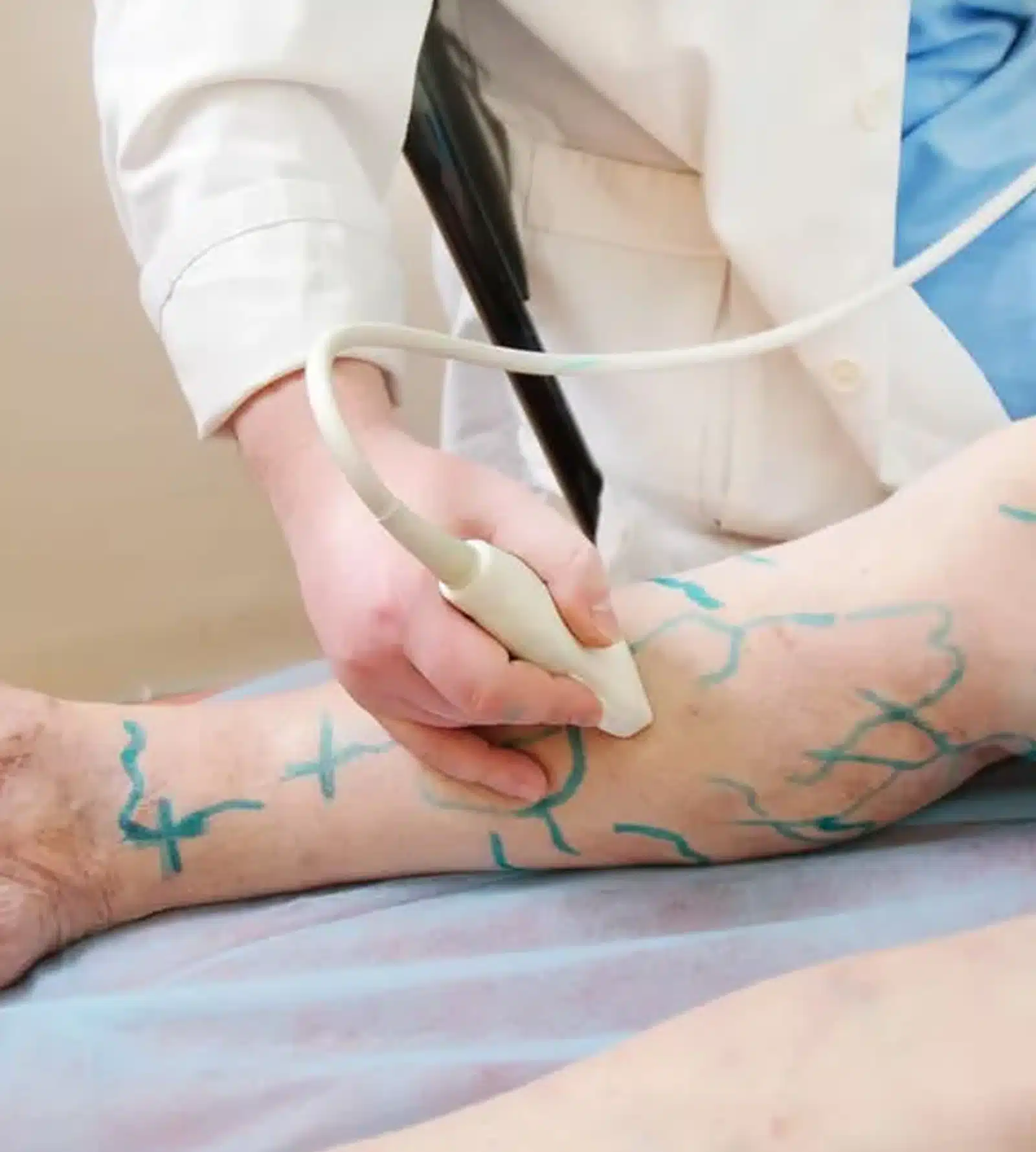 Sclerotherapy Sclerotherapy