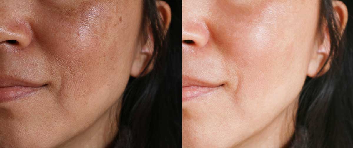 Skin Discoloration Treatment Winter Park FL