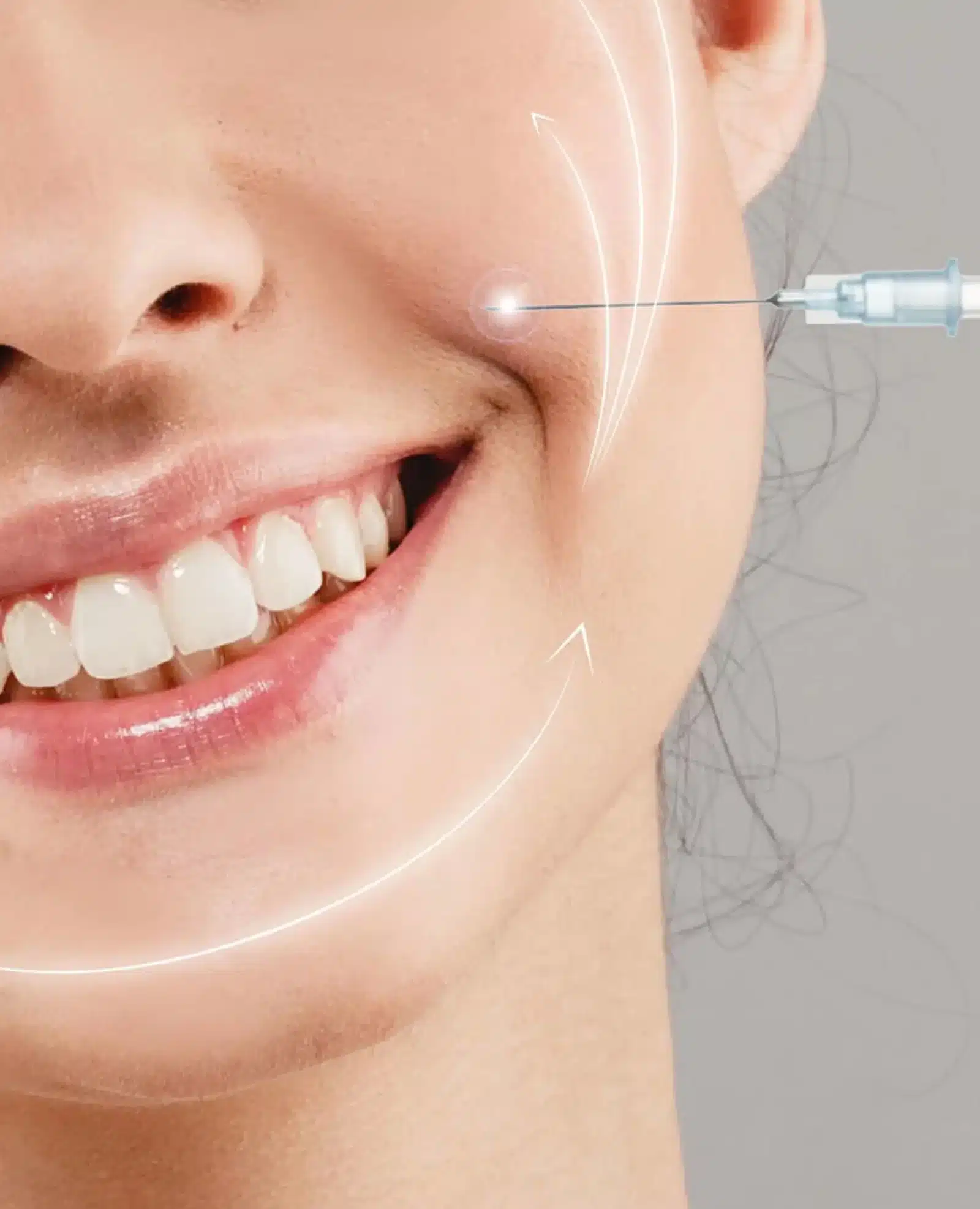 Smile Line Treatment