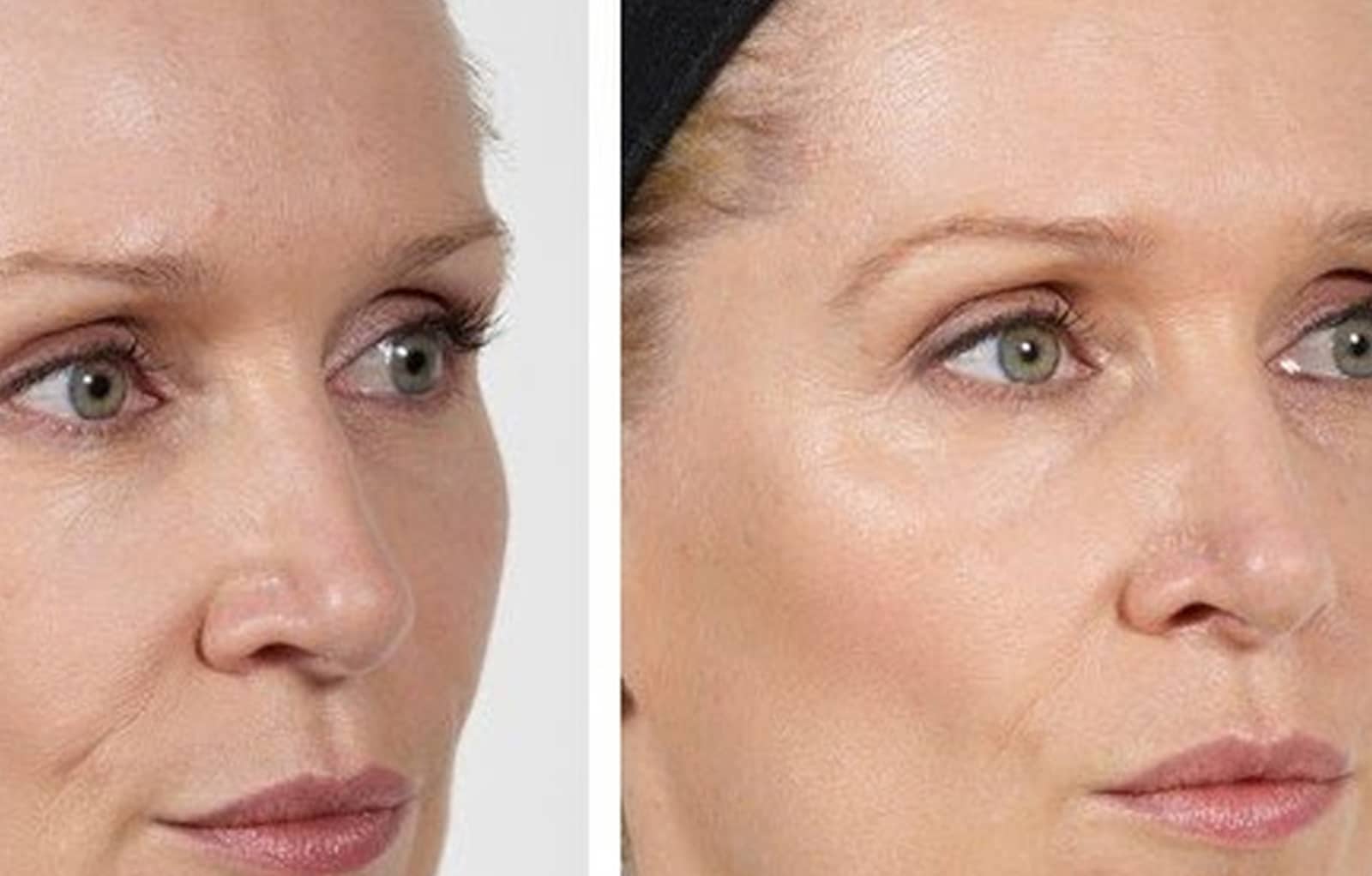 Temple Filler Consultation