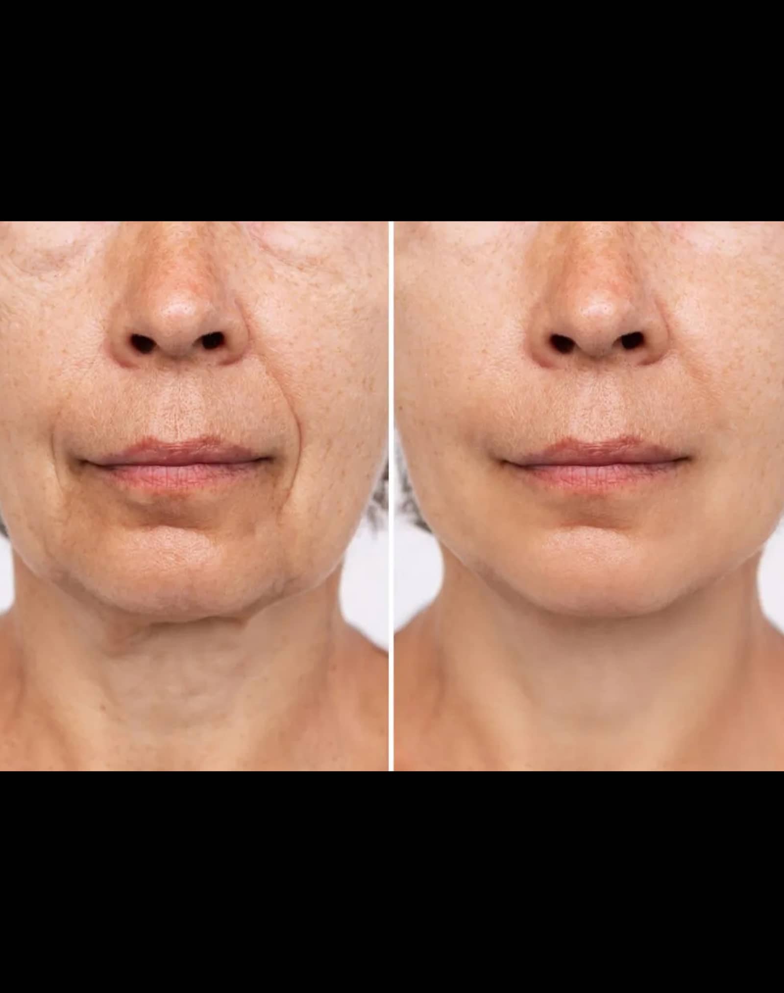 Temple Fillers vs. Surgical Procedures-Recovered Temple Fillers vs. Surgical Procedures-Recovered