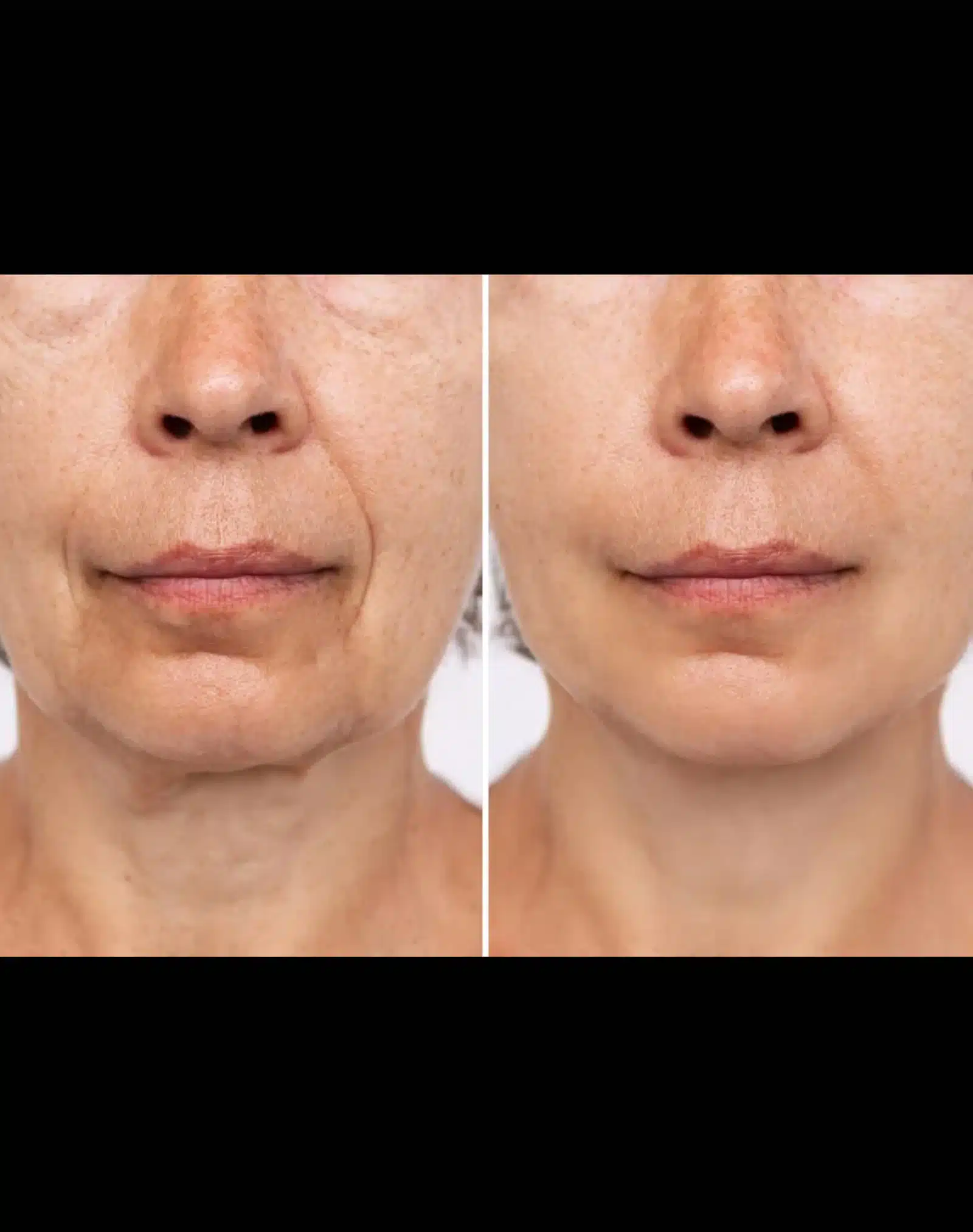 Temple Fillers vs. Surgical Procedures-Recovered Temple Fillers vs. Surgical Procedures-Recovered