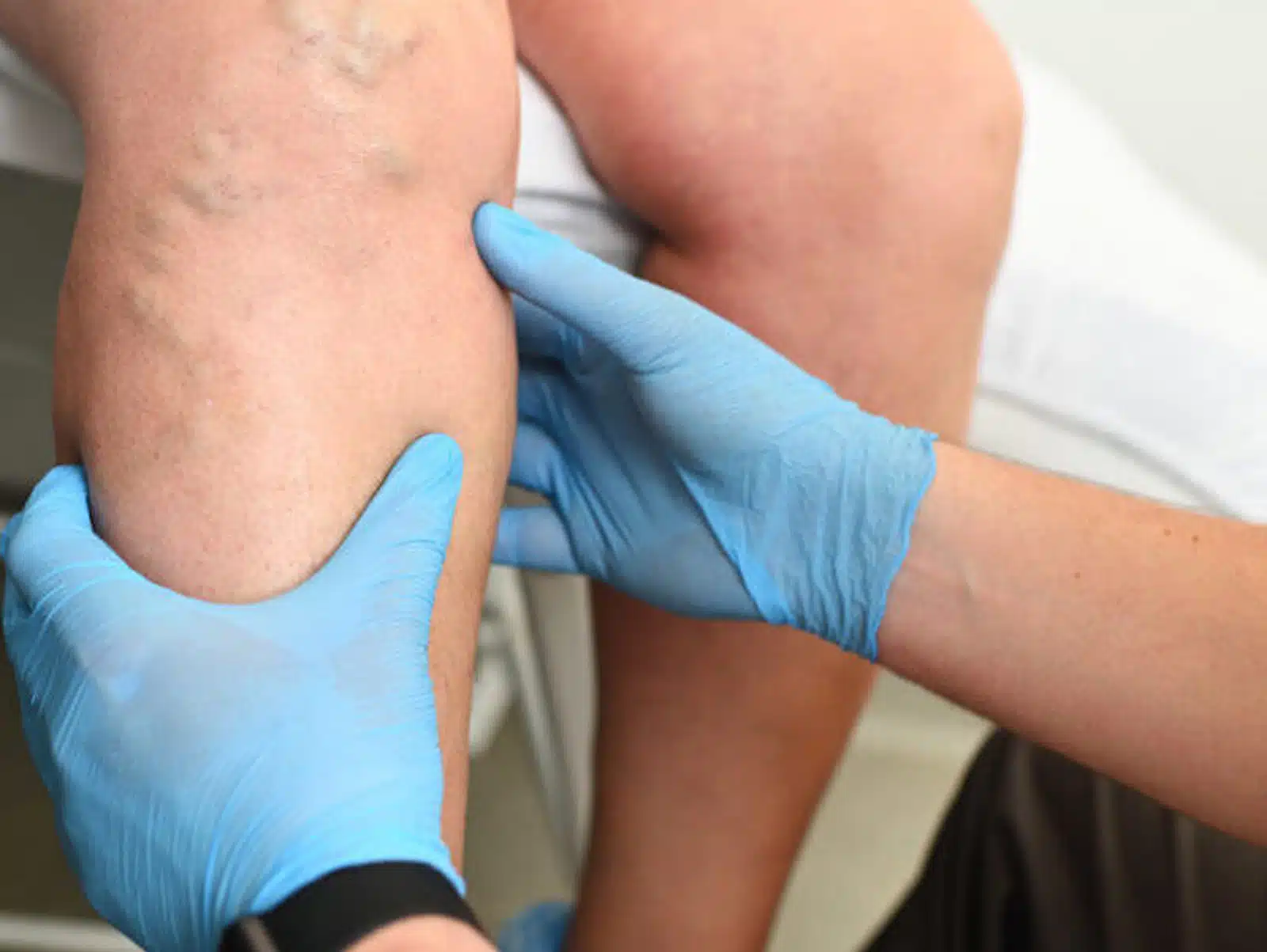 Varicose Vein Treatment Options Varicose Vein Treatment Options