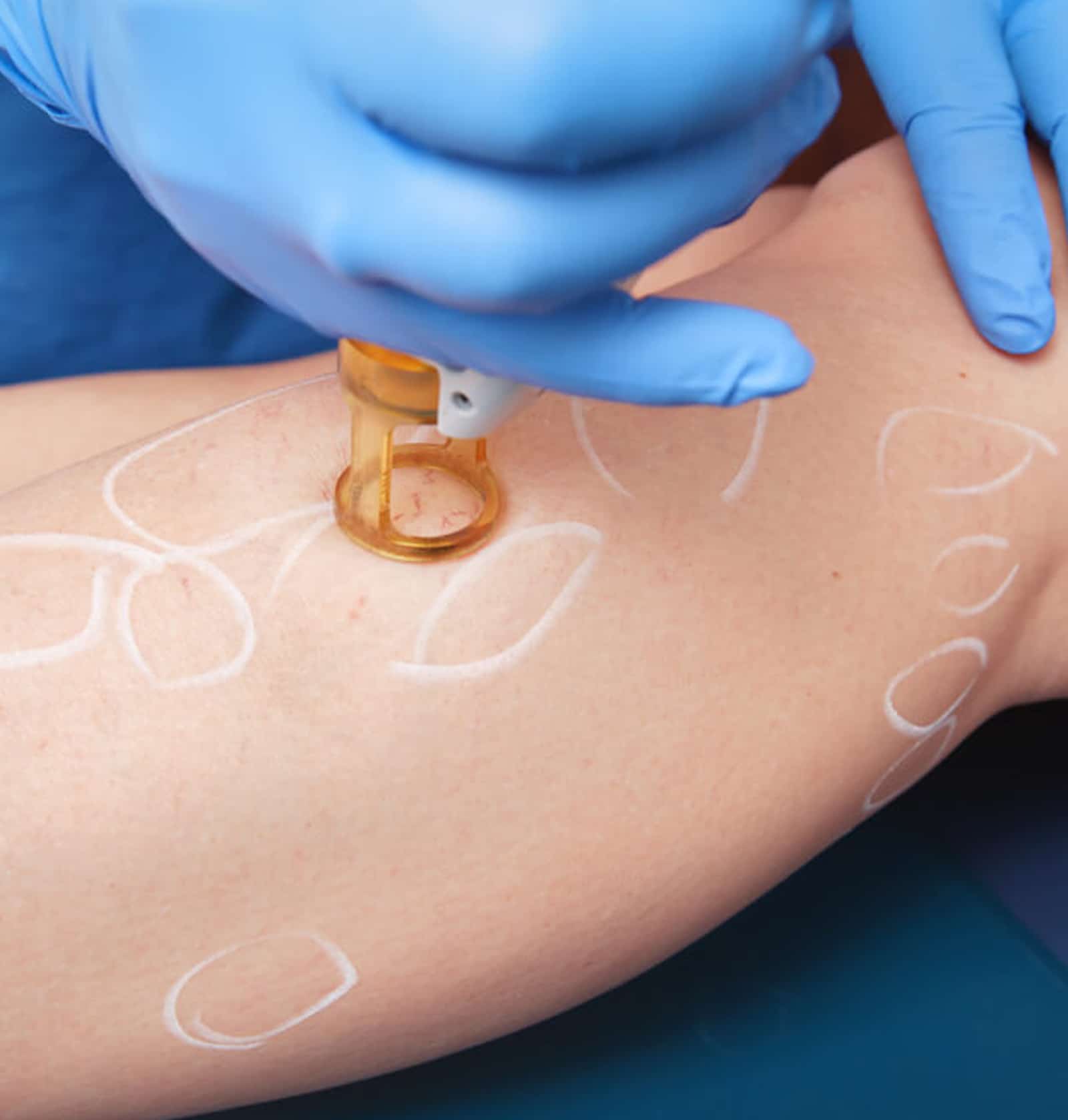 Varicose Veins Treatment Winter Parkk FL Varicose Veins Treatment Winter Parkk FL
