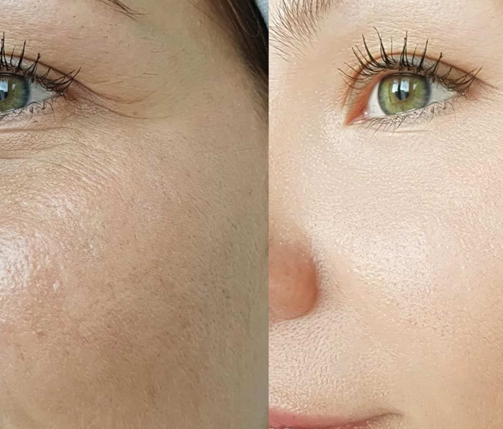 CO2 Laser Treatment CO2 Laser Treatment
