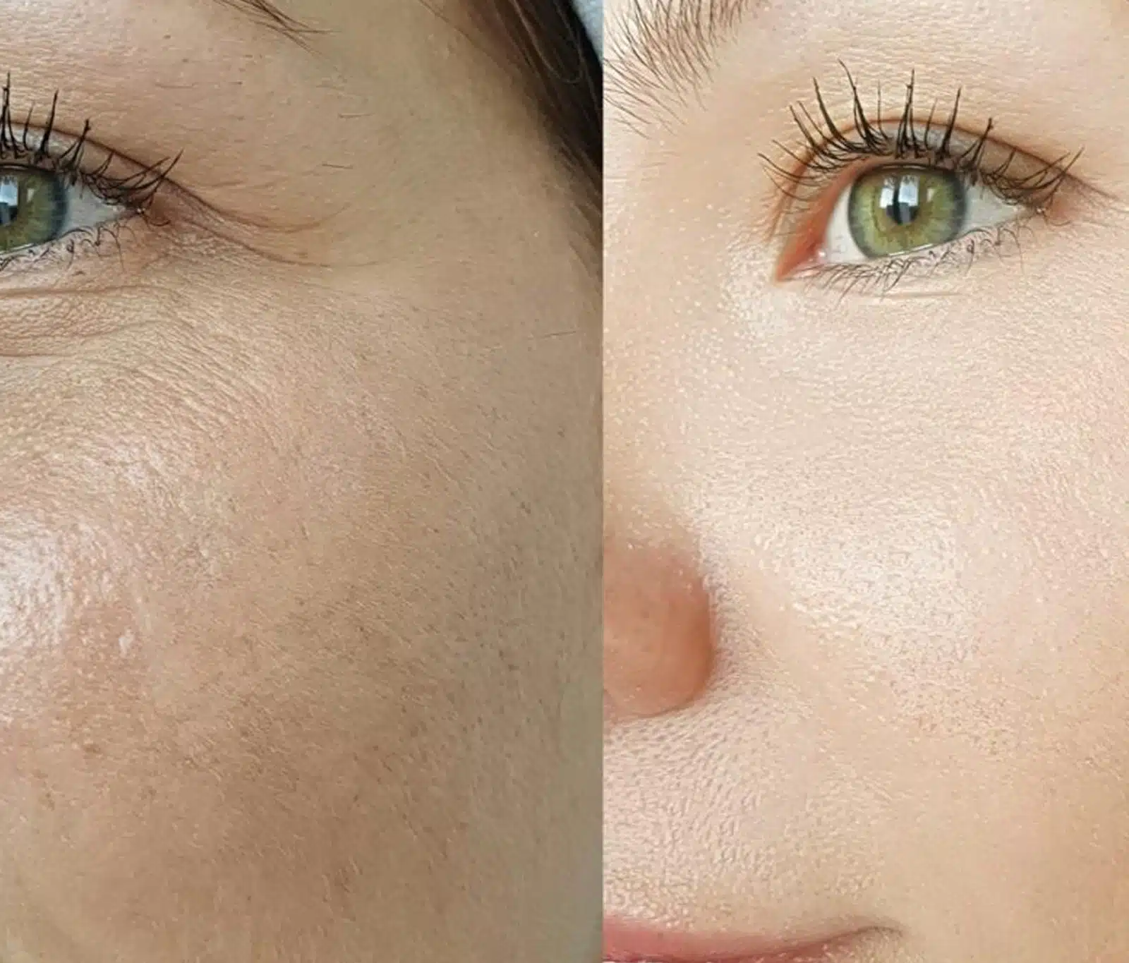 CO2 Laser Treatment CO2 Laser Treatment
