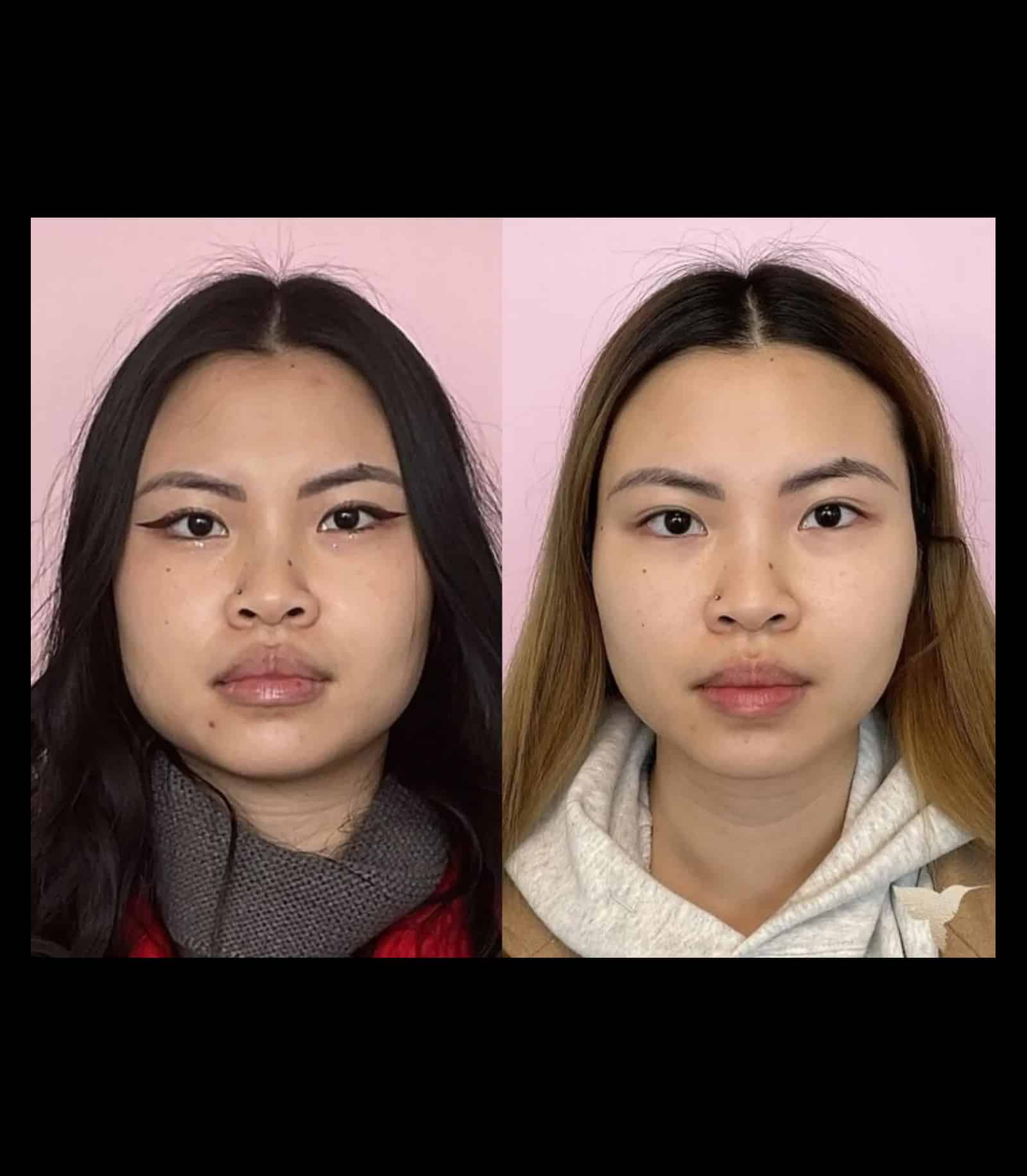 Compared to dermal fillers