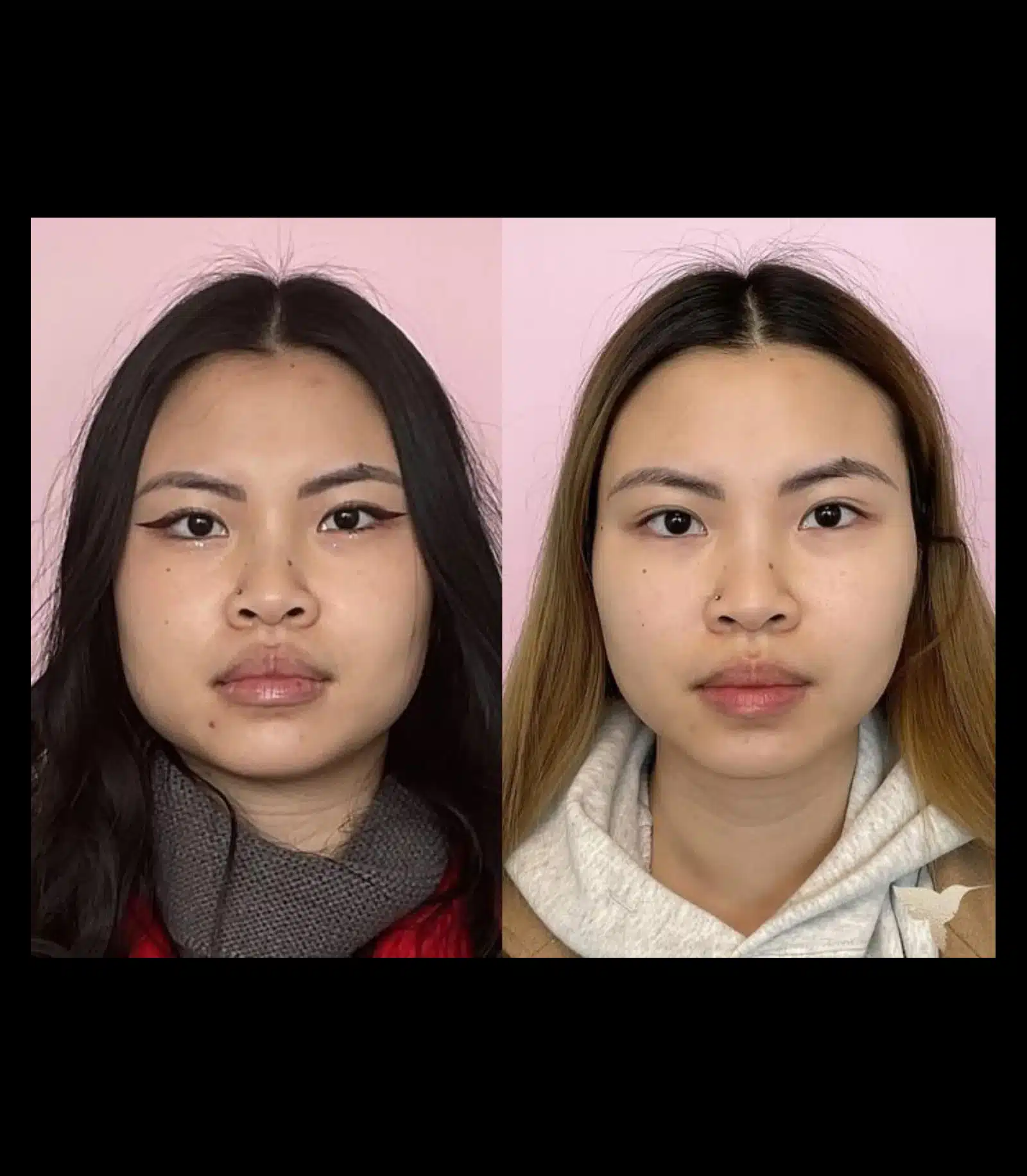 Compared to dermal fillers Compared to dermal fillers