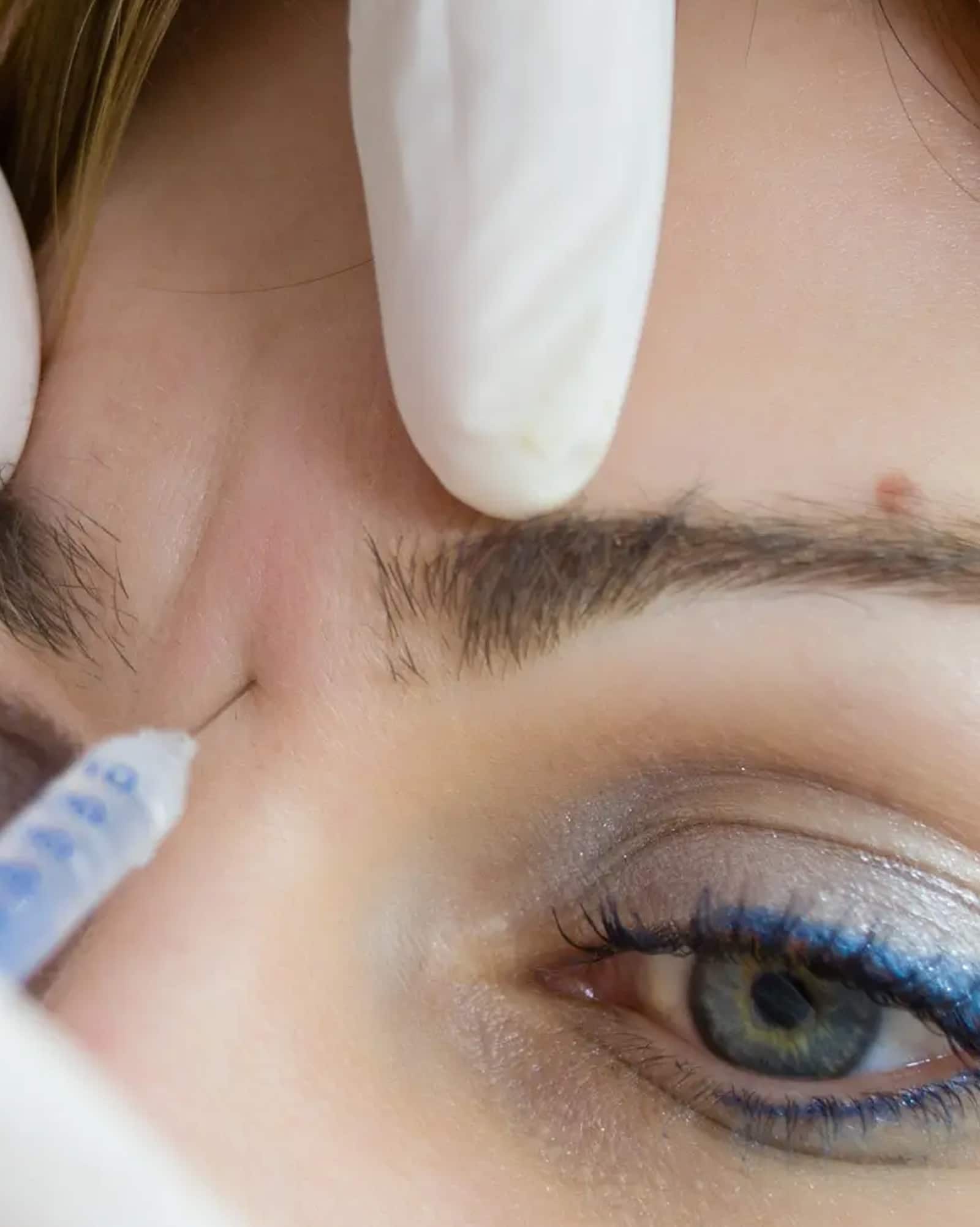 Dysport Brow Lift in Winter Park Dysport Brow Lift in Winter Park