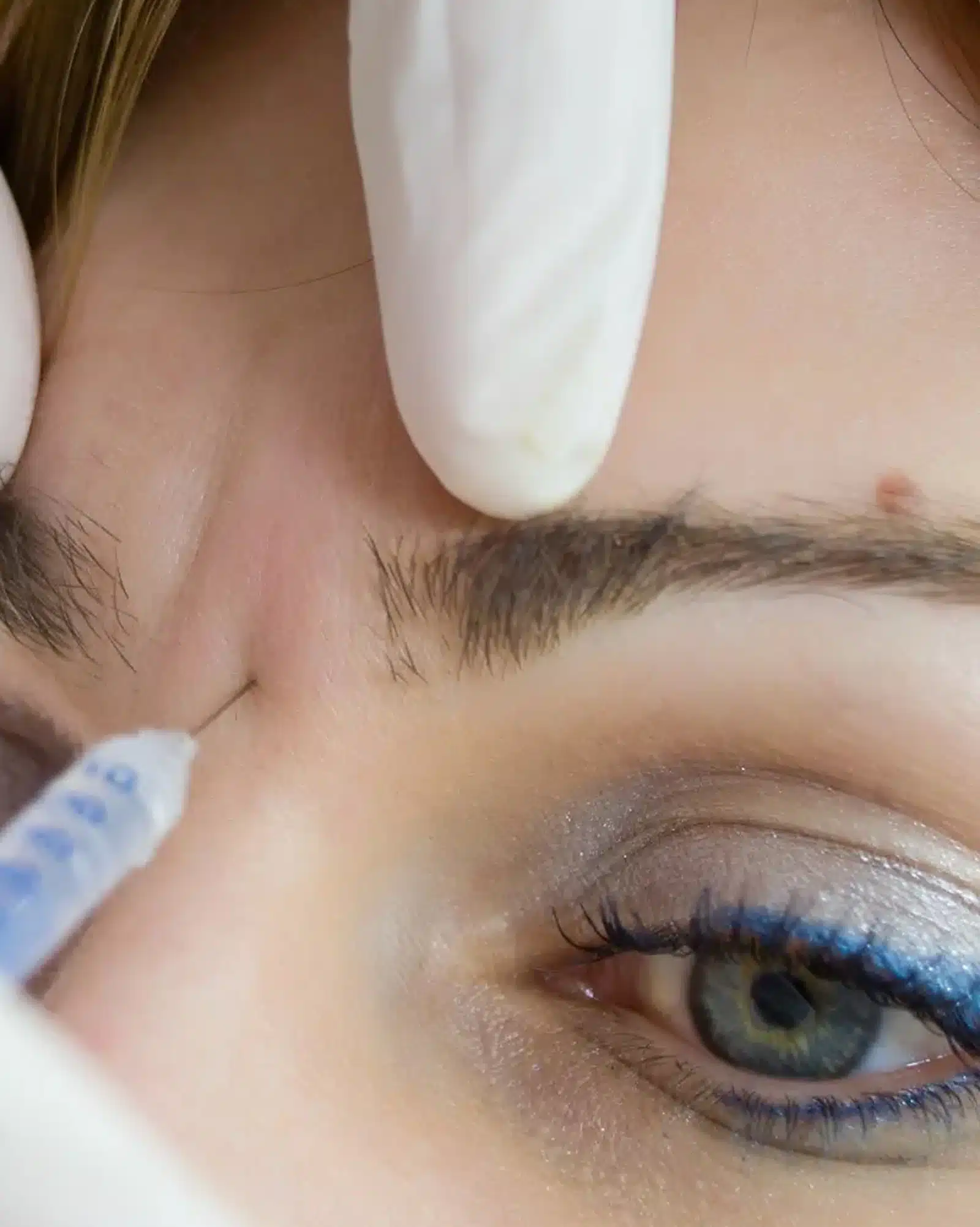 Dysport Brow Lift in Winter Park Dysport Brow Lift in Winter Park