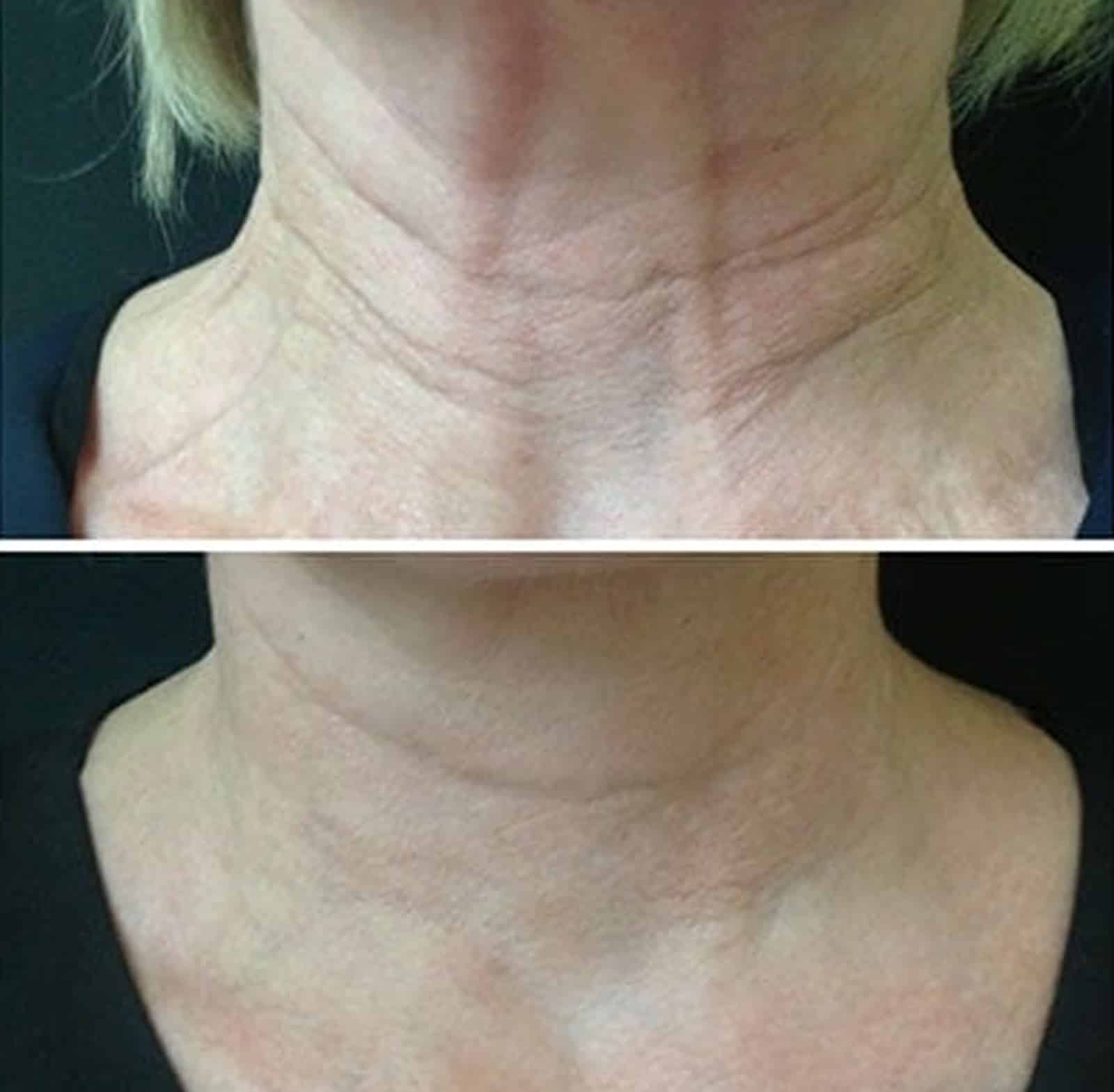 Dysport Ideal for Neck Line Reduction