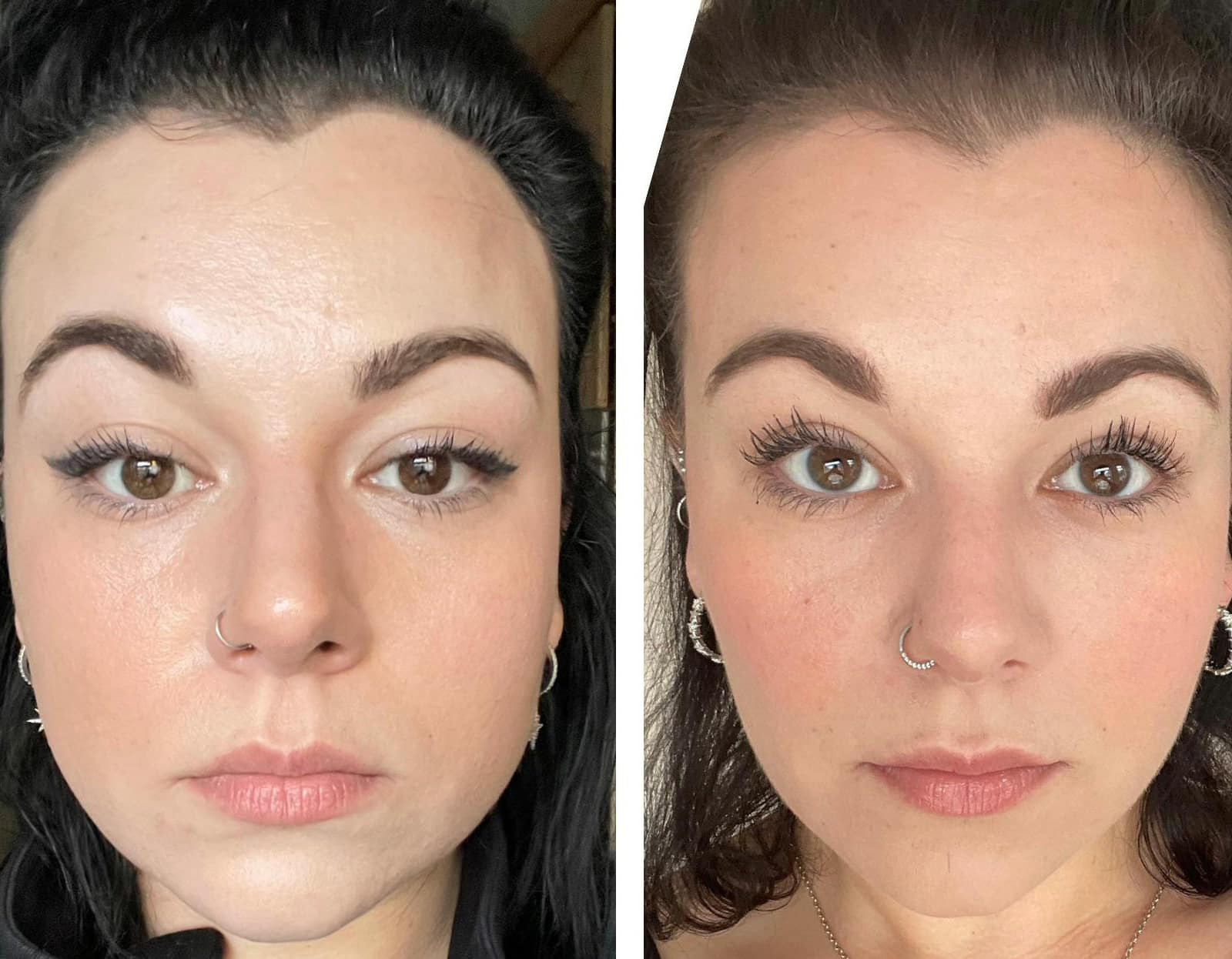 Dysport Jawline Contouring in Winter Park