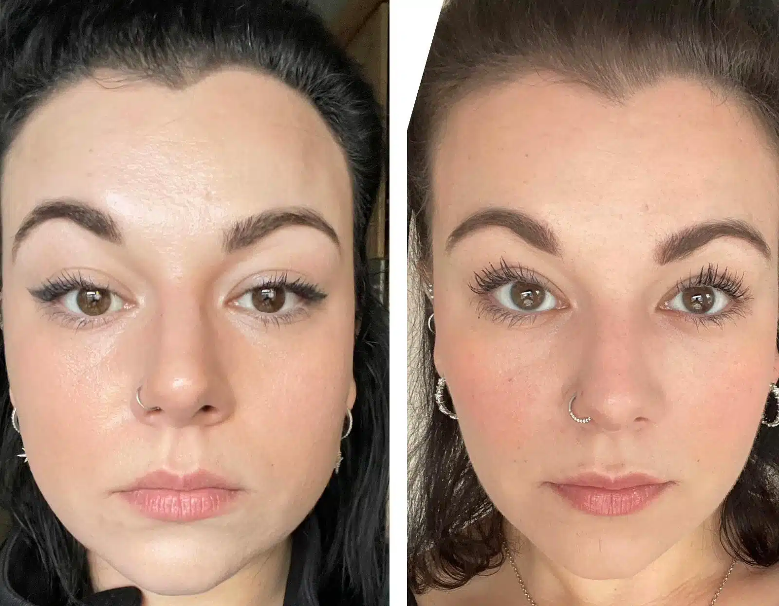 Dysport Jawline Contouring in Winter Park