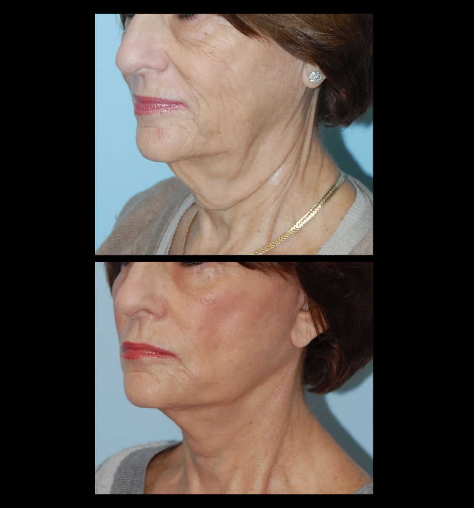 Dysport Neck Line Reduction