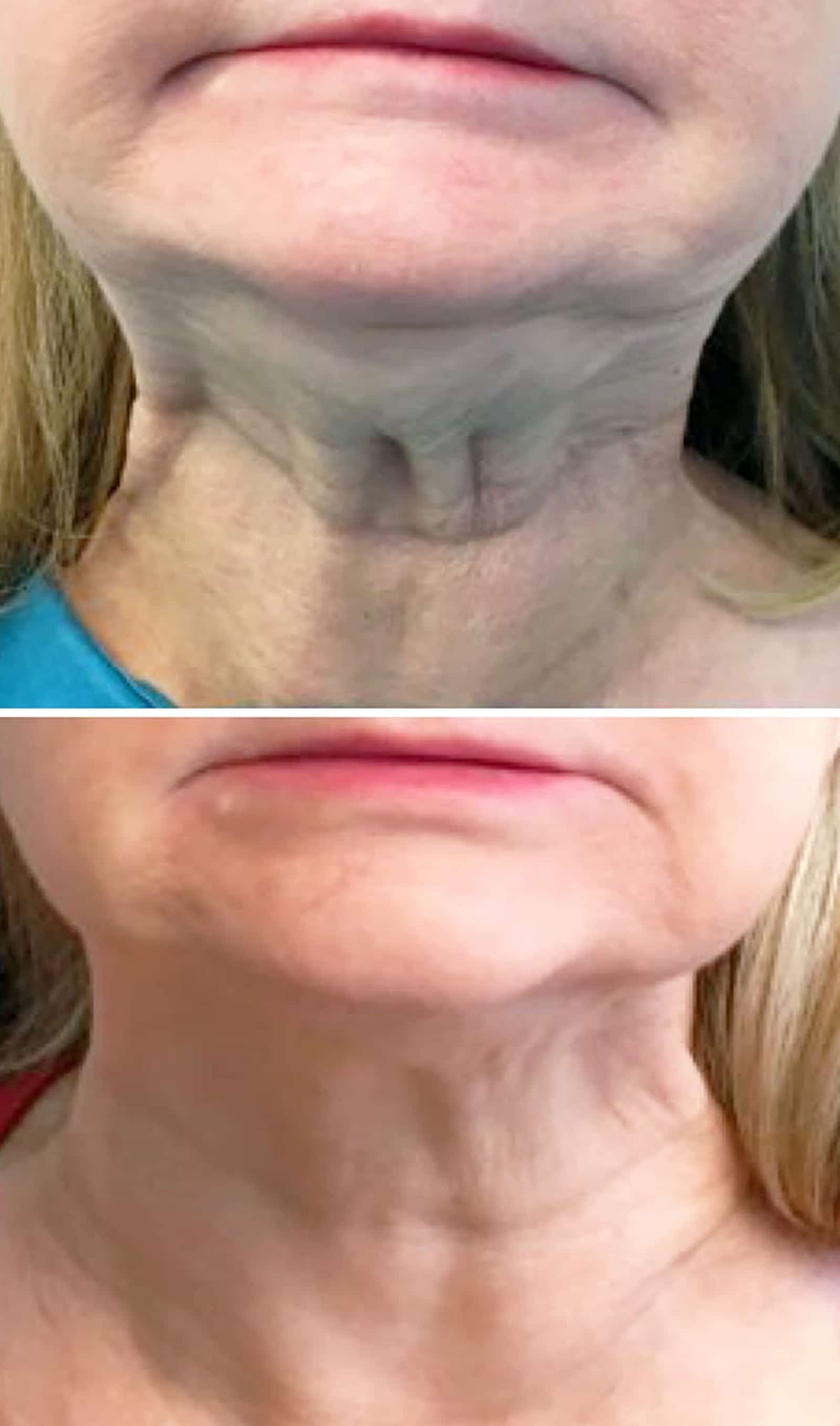 Dysport Treatment at Wymore Laser