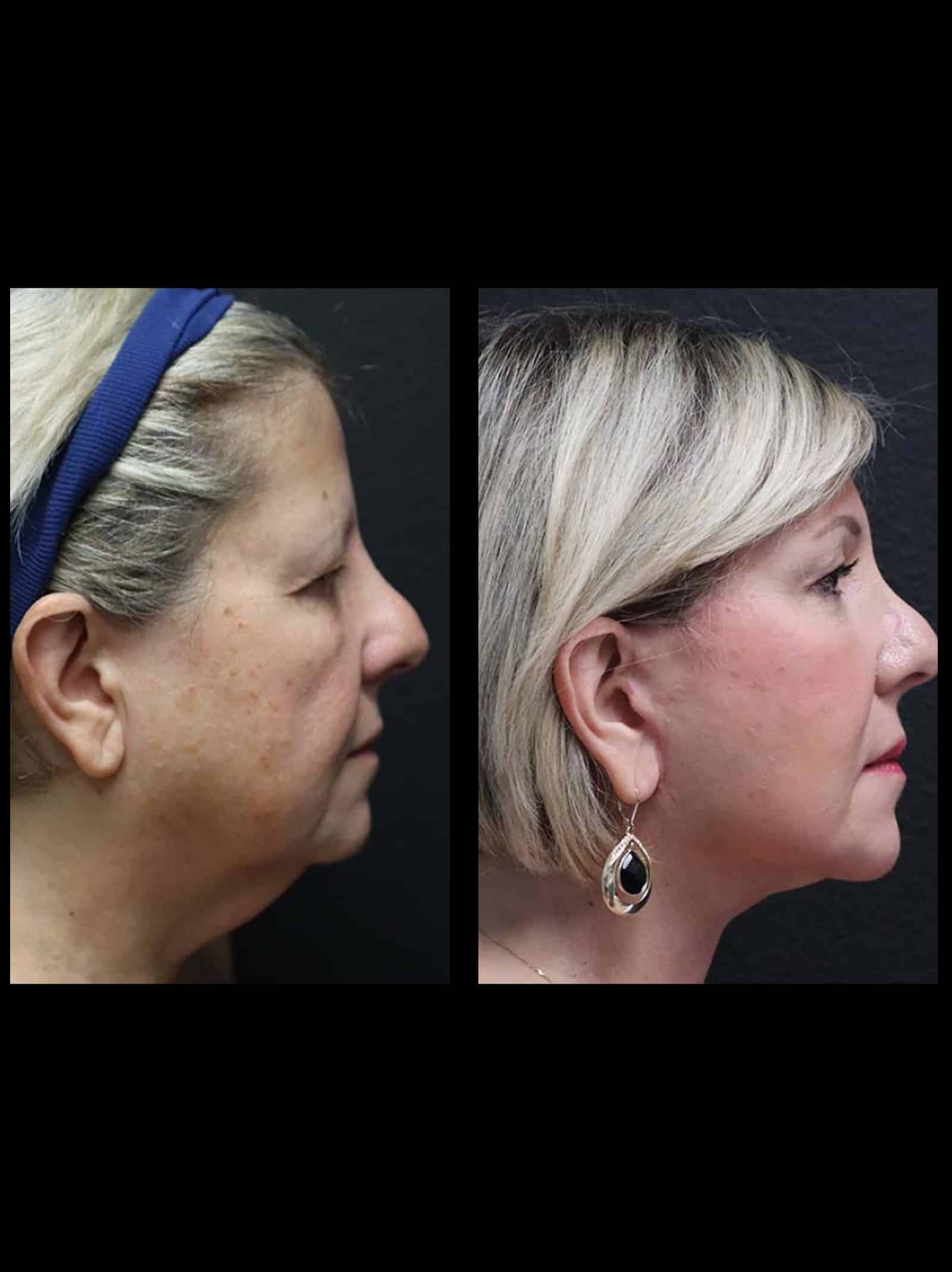 Dysport for Neck Smoothing