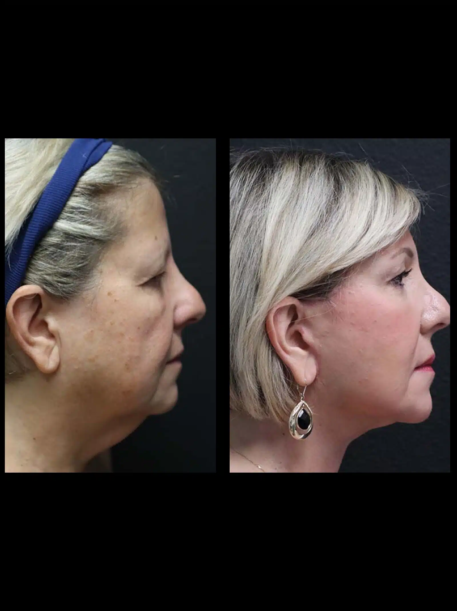 Dysport for Neck Smoothing