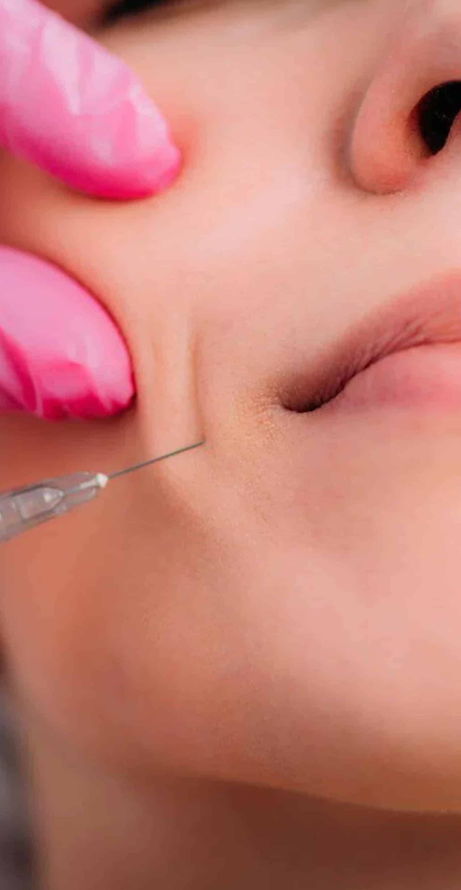 Injectable Fillers at Wymore Laser Injectable Fillers at Wymore Laser