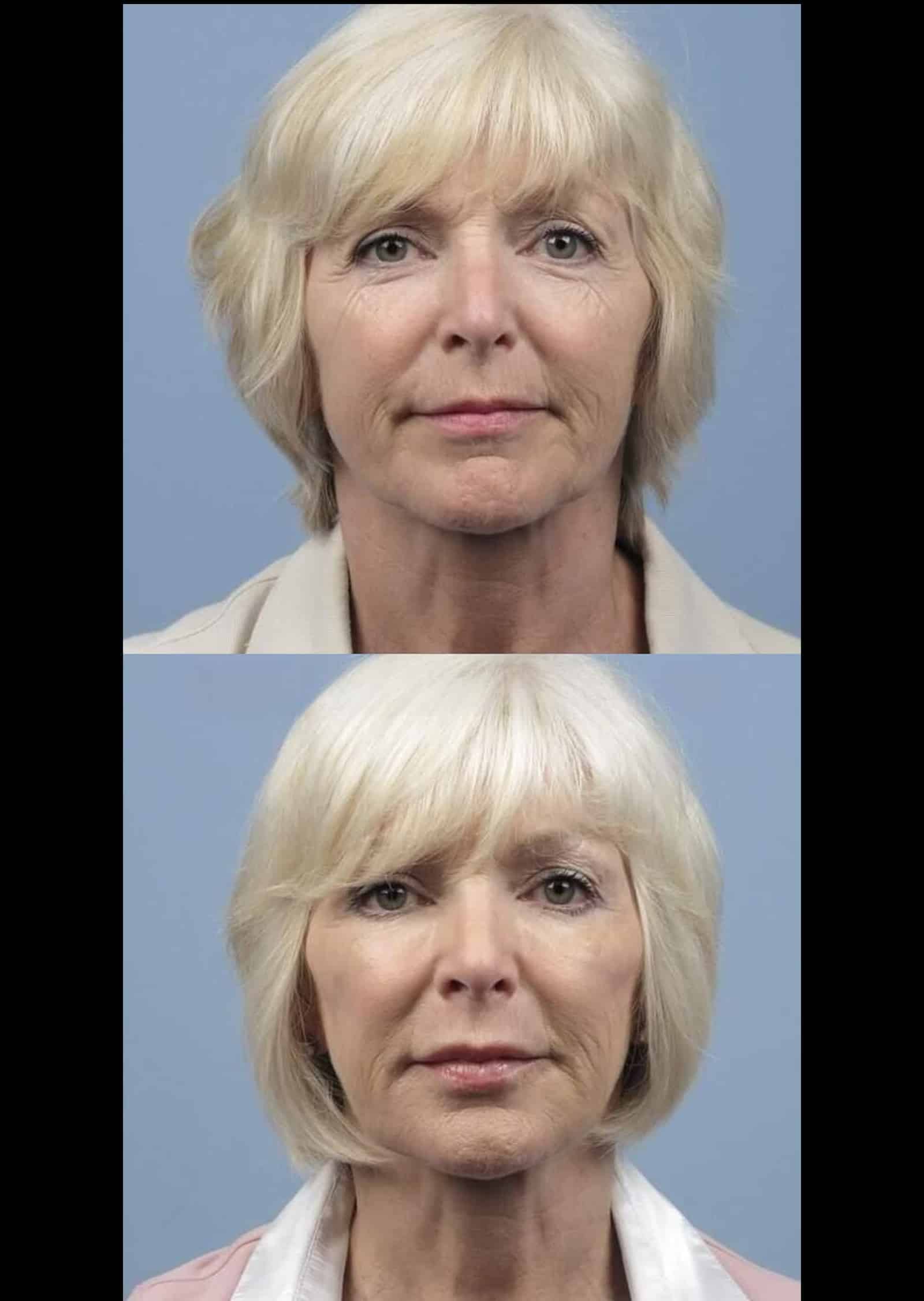 Laser Skin Resurfacing Laser Skin Resurfacing