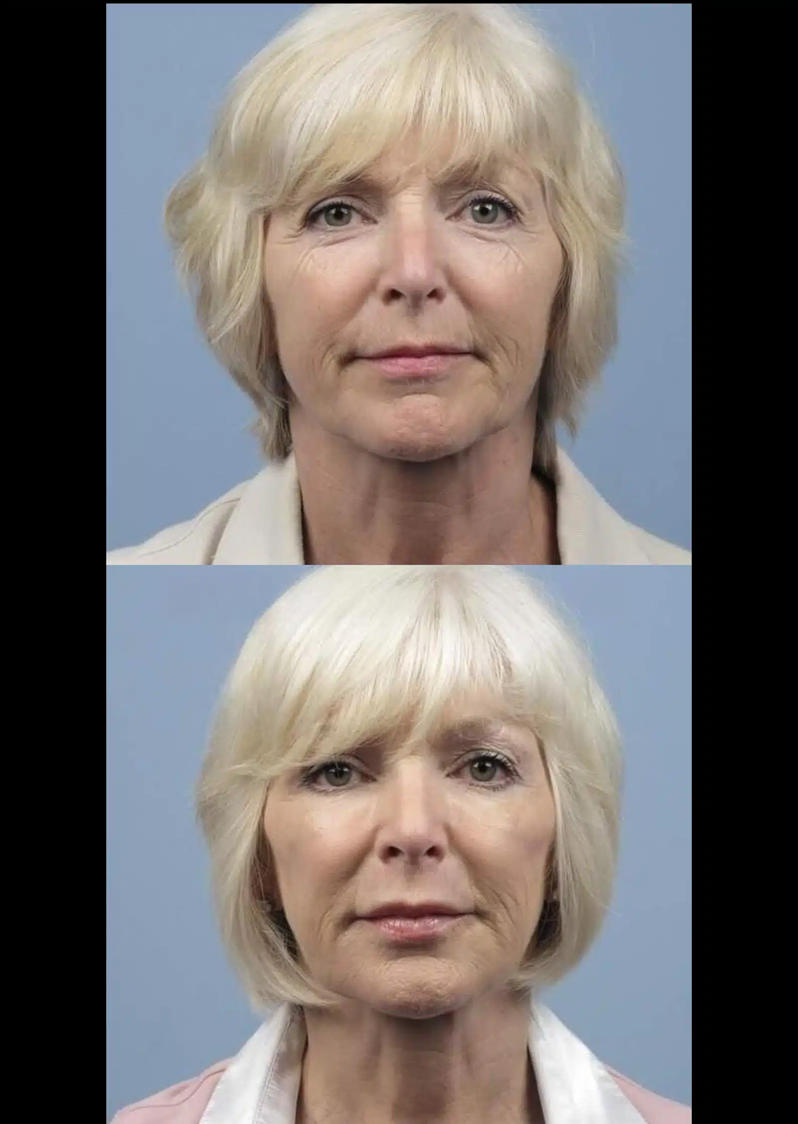 Laser Skin Resurfacing