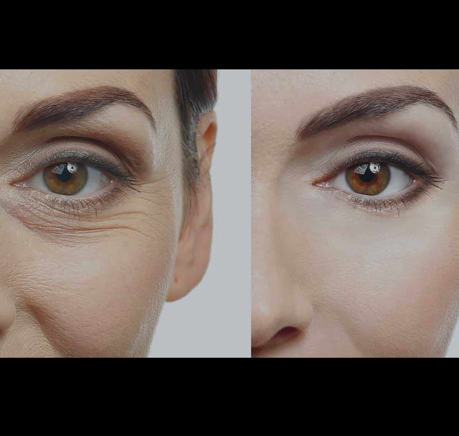 Long-Term Results and Skin Rejuvenation Long-Term Results and Skin Rejuvenation