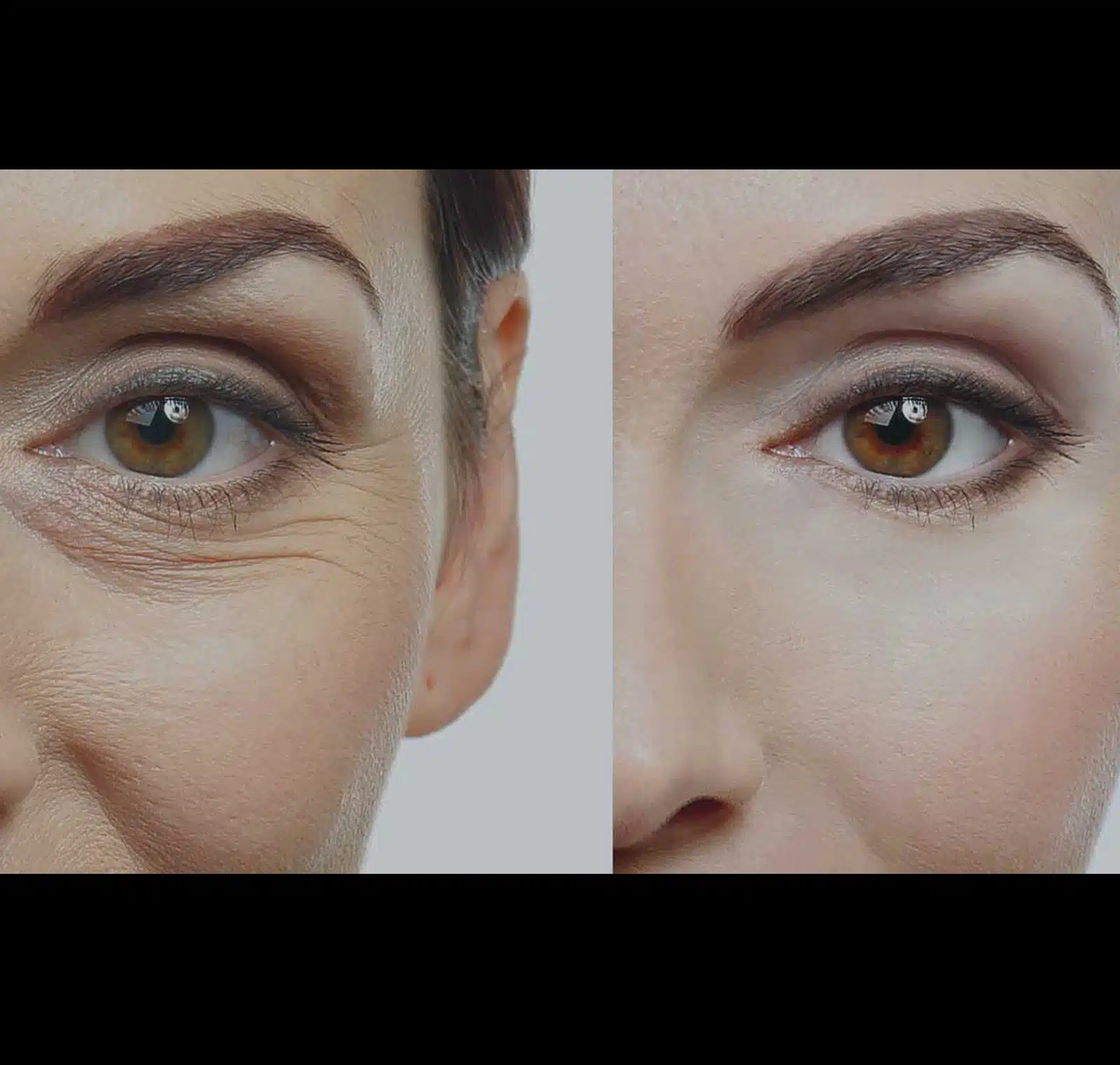 Long-Term Results and Skin Rejuvenation Long-Term Results and Skin Rejuvenation