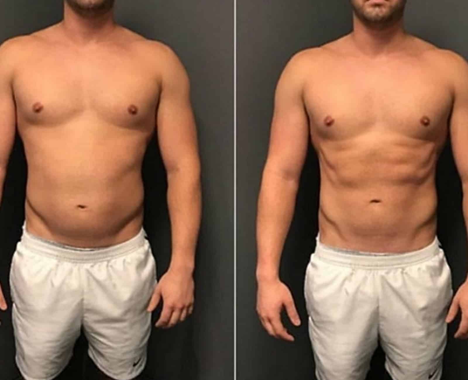 Non-Surgical Body Sculpting Non-Surgical Body Sculpting