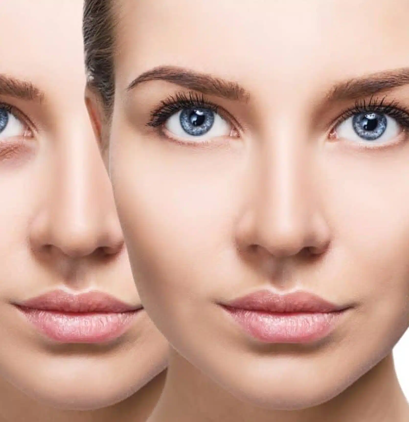 Step-by-Step Tear Trough Treatment