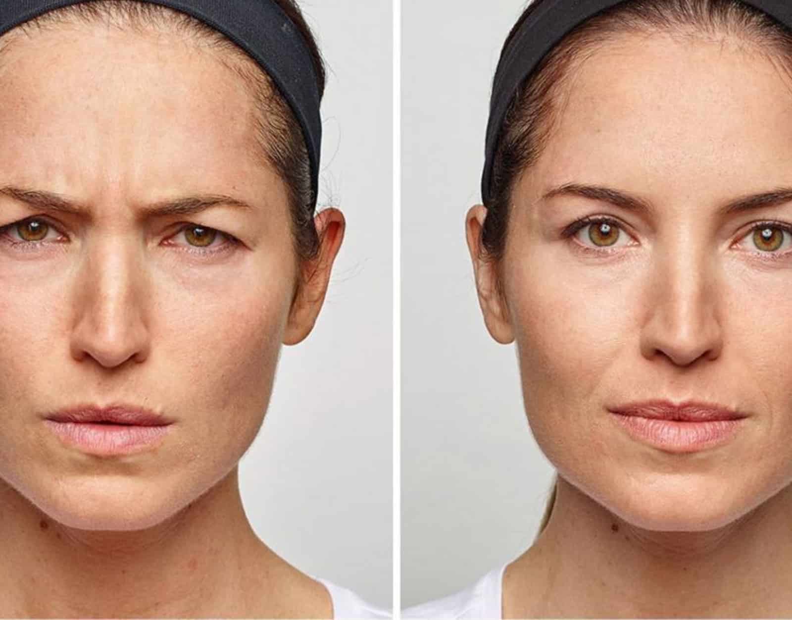 Transform Your Chin with Dysport