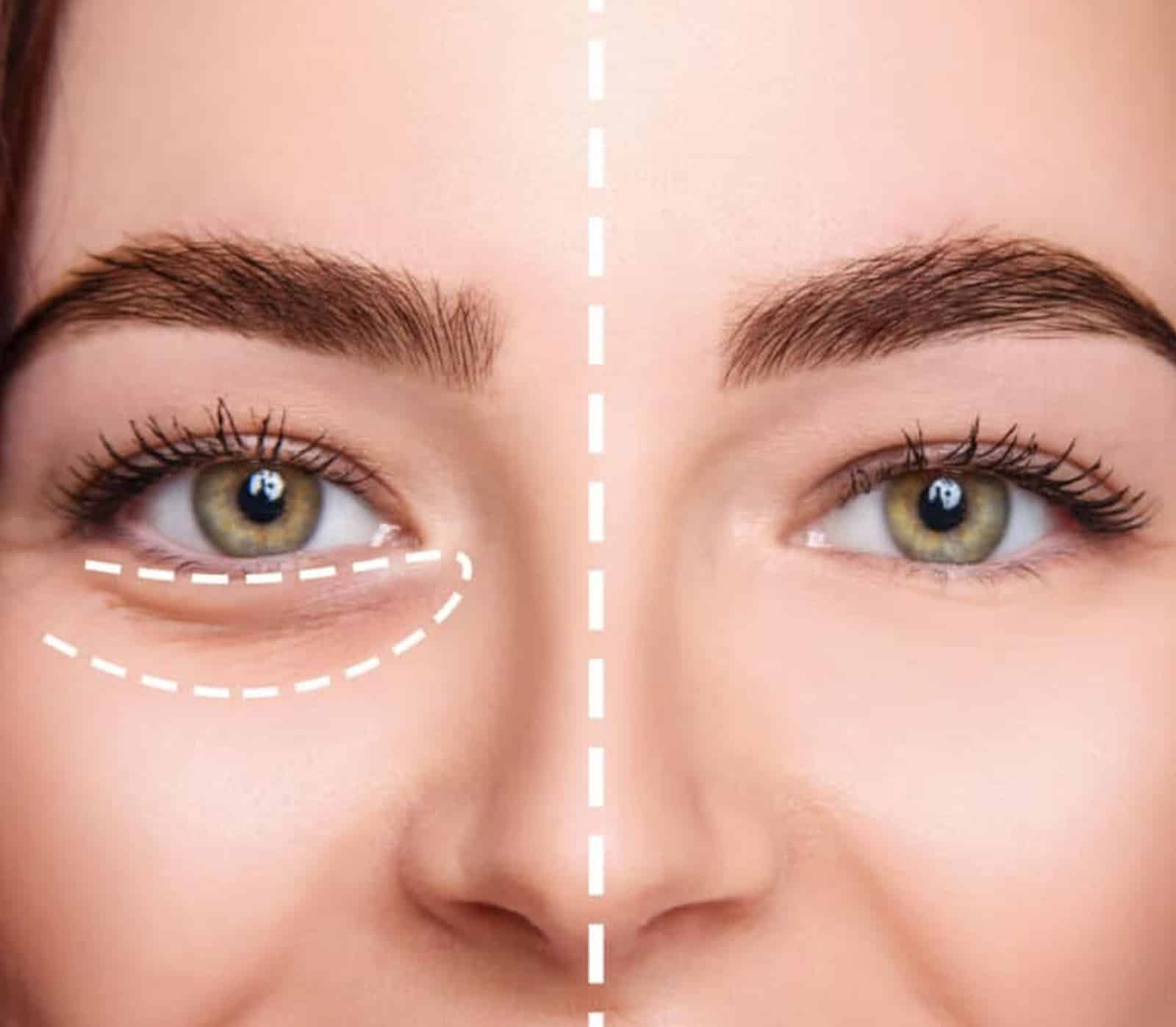 Under Eye Filler Treatment