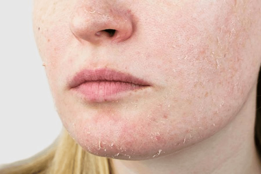 Facial Redness in Winter Park.