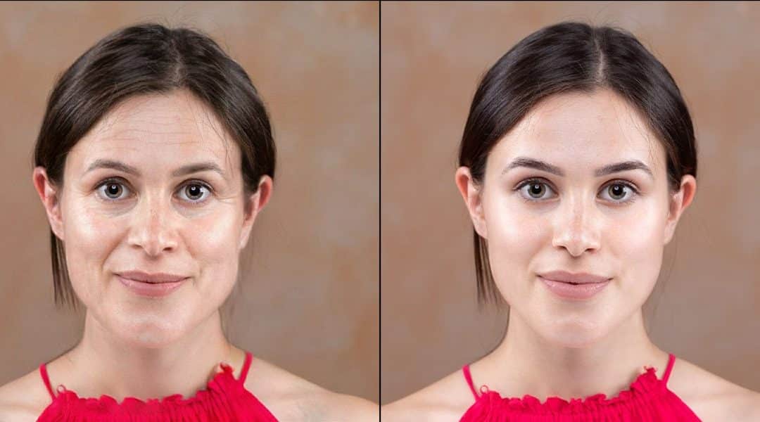 Cool Peel Skin Resurfacing Orlando – Modern Laser Technology for Clearer, Healthier Skin