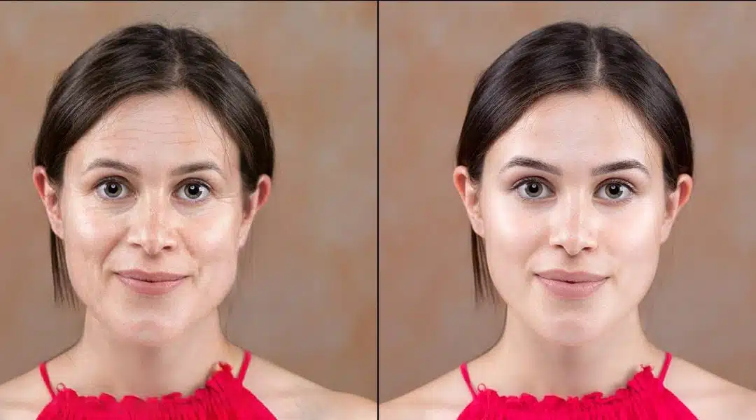 Cool Peel Skin Resurfacing Orlando – Modern Laser Technology for Clearer, Healthier Skin