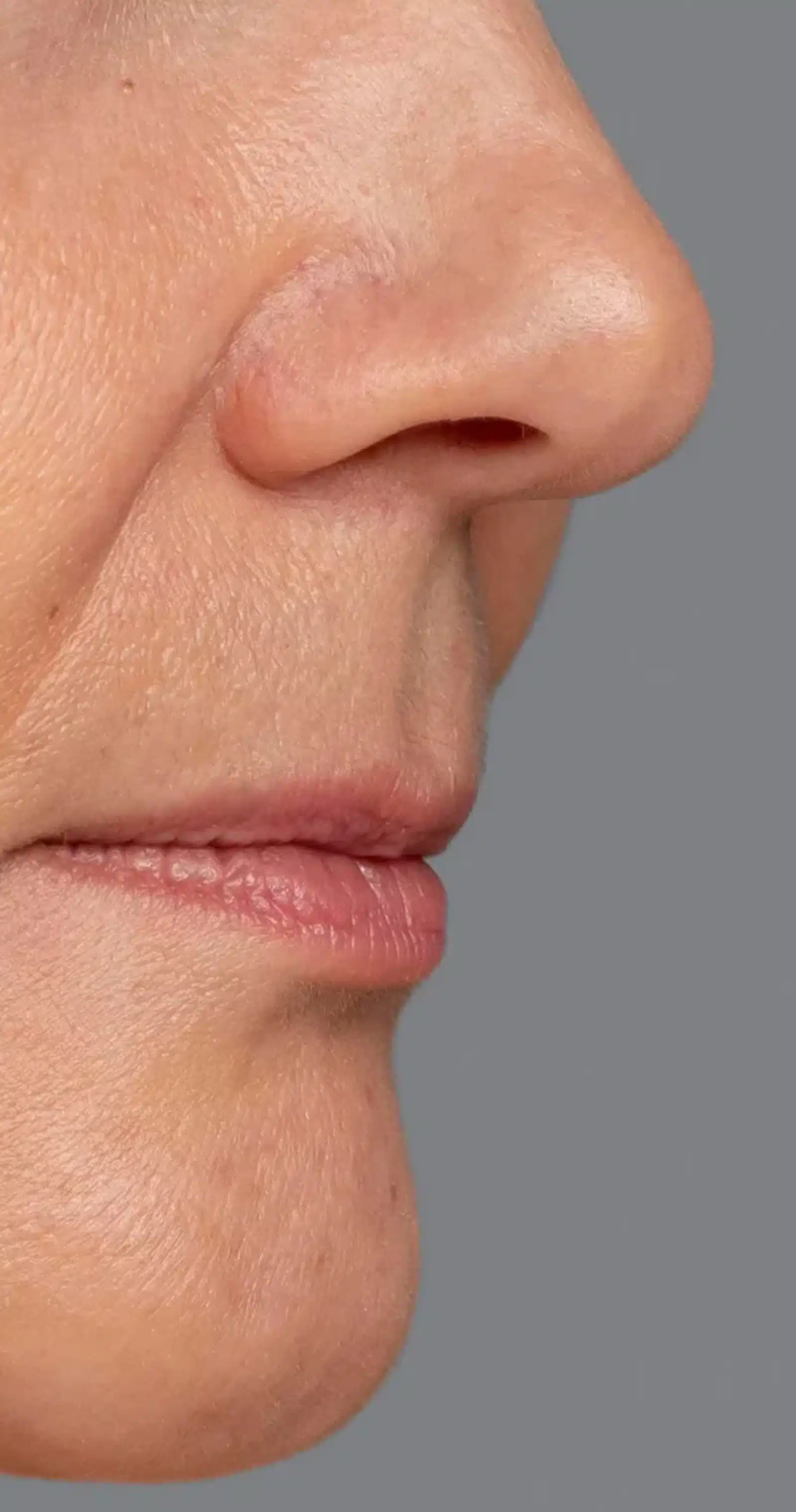 Dermal Fillers for Structural Support Happens During Your Laser Treatment Session