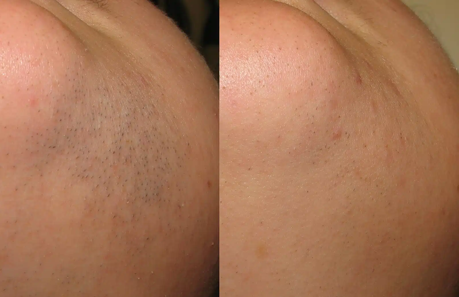 Skin After Laser Hair Removal Botox or Dysport