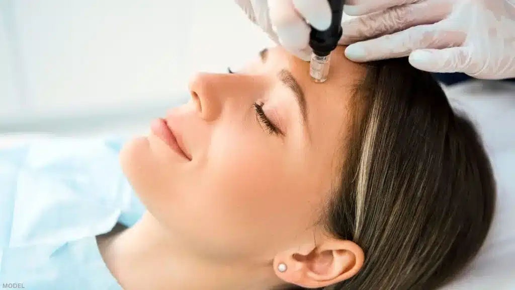 micro needling treatment winter park florida