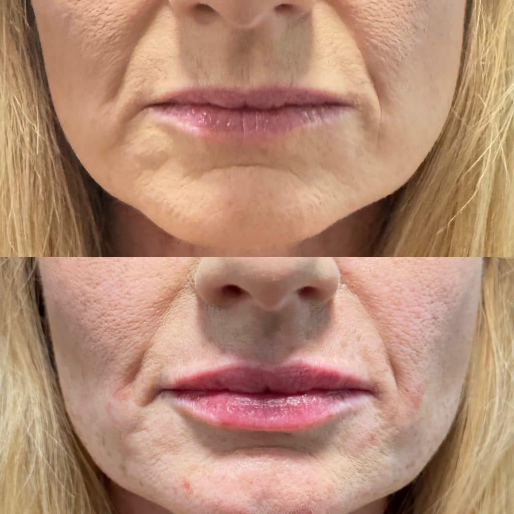 smile line treatment orlando