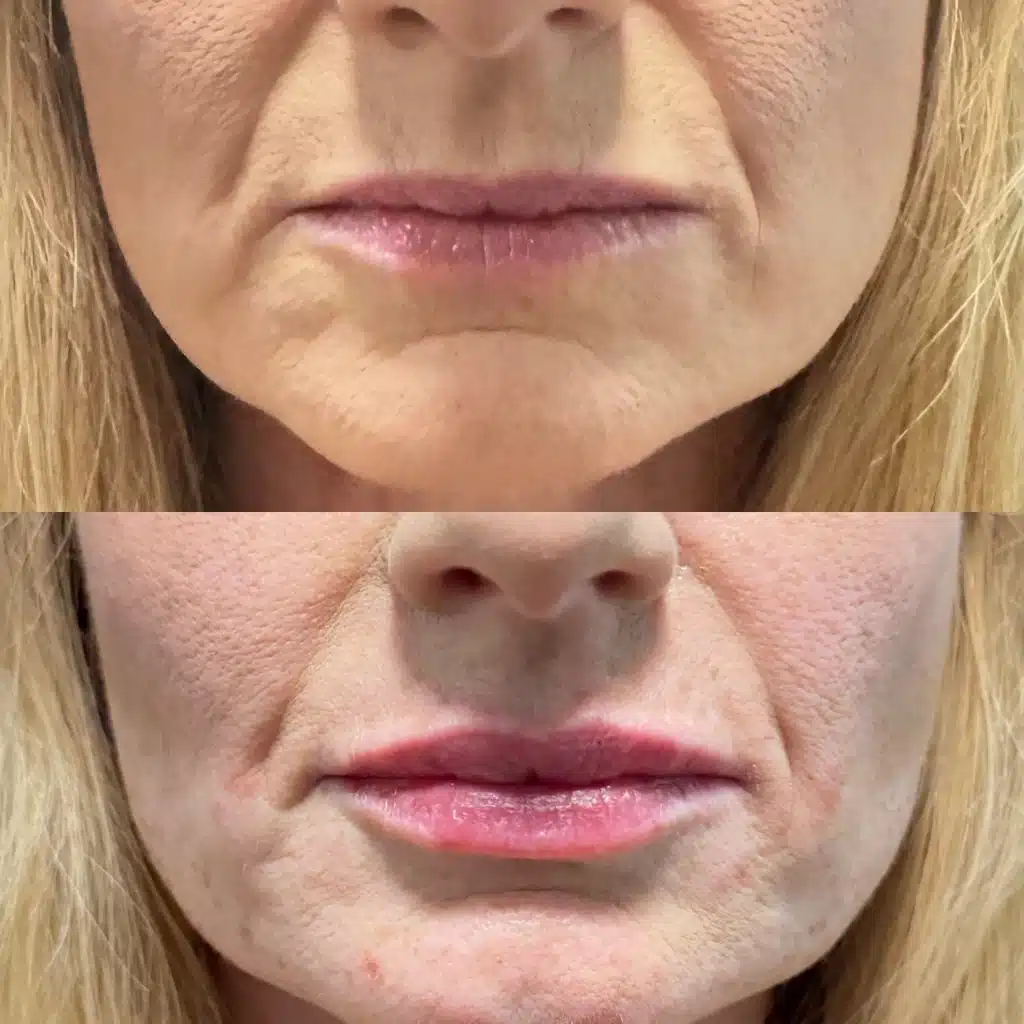 smile line treatment orlando