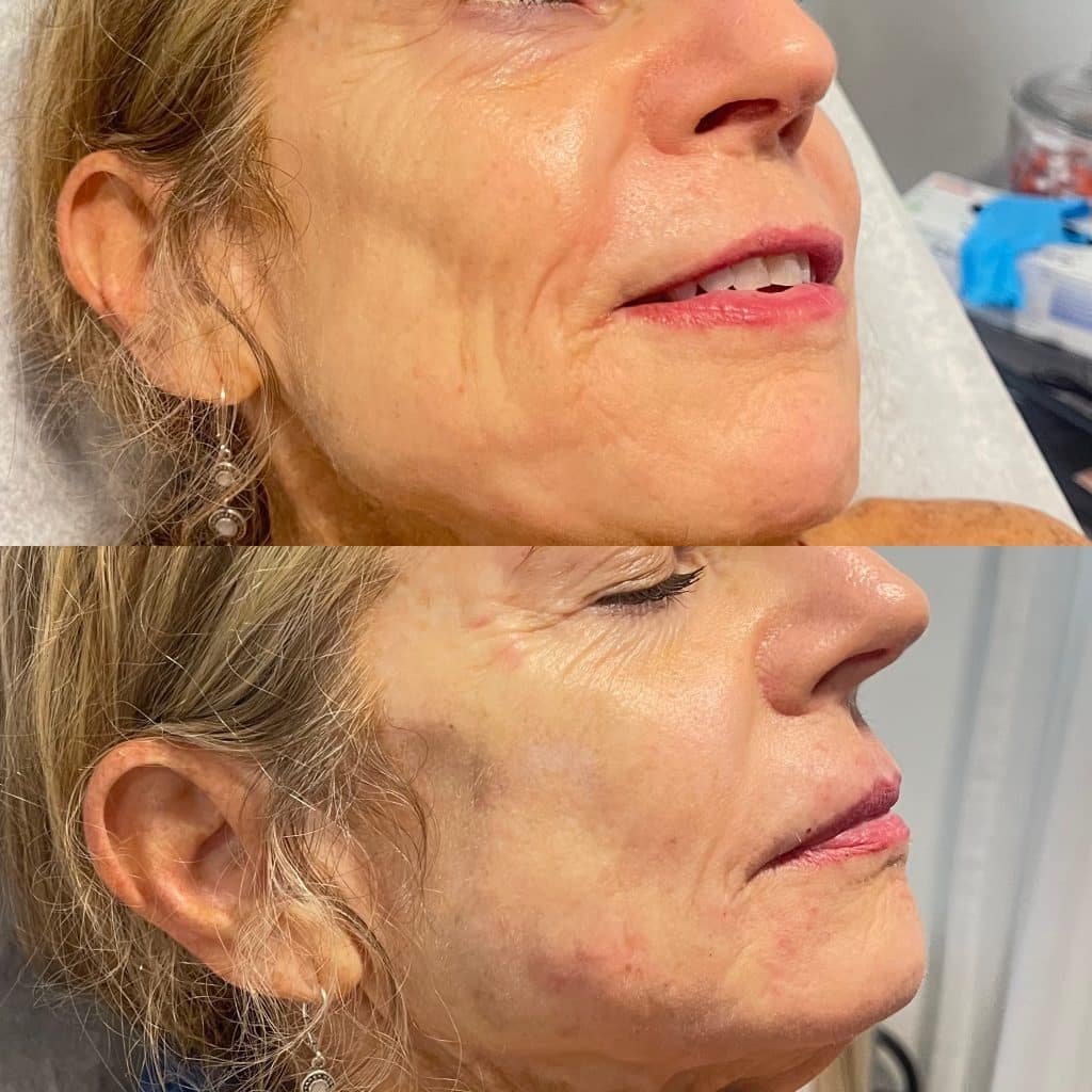 smile line treatment orlando