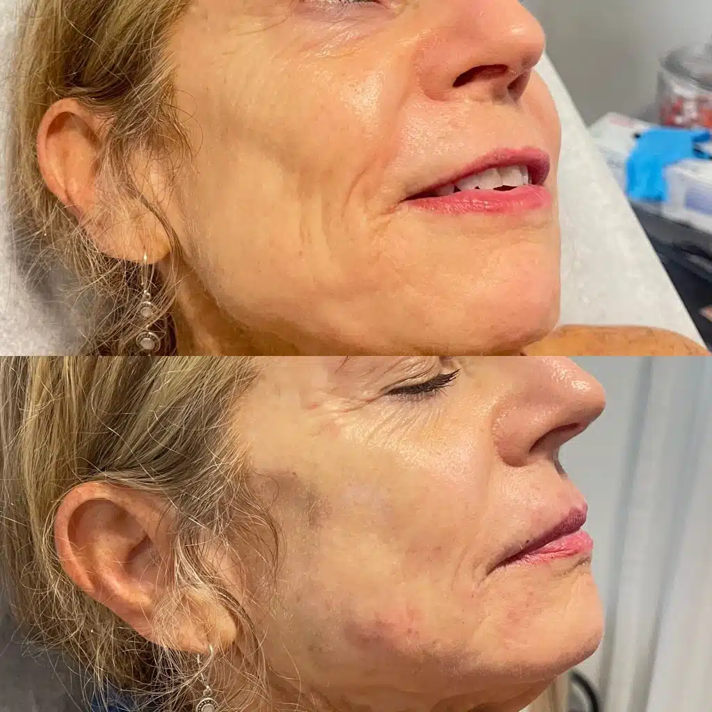 smile line treatment orlando