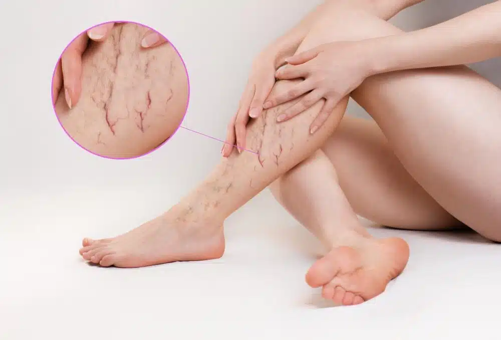 spider vein treatment