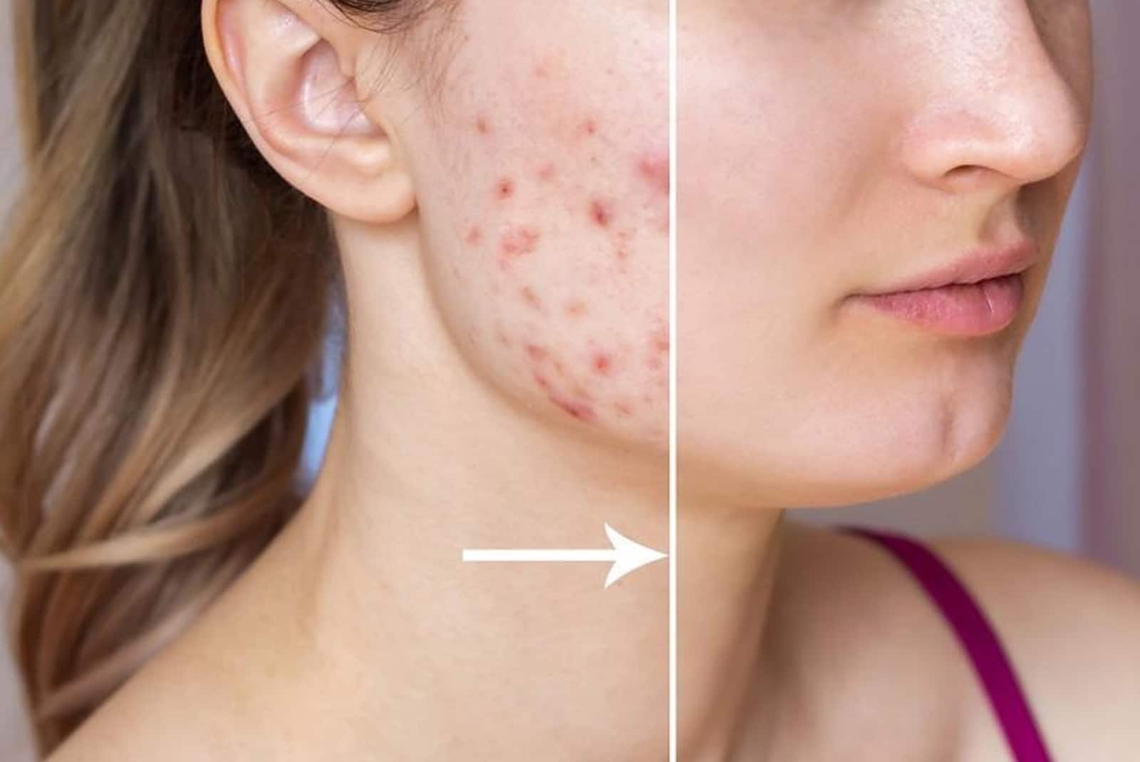 Acne scars treatment Fine lines & wrinkles