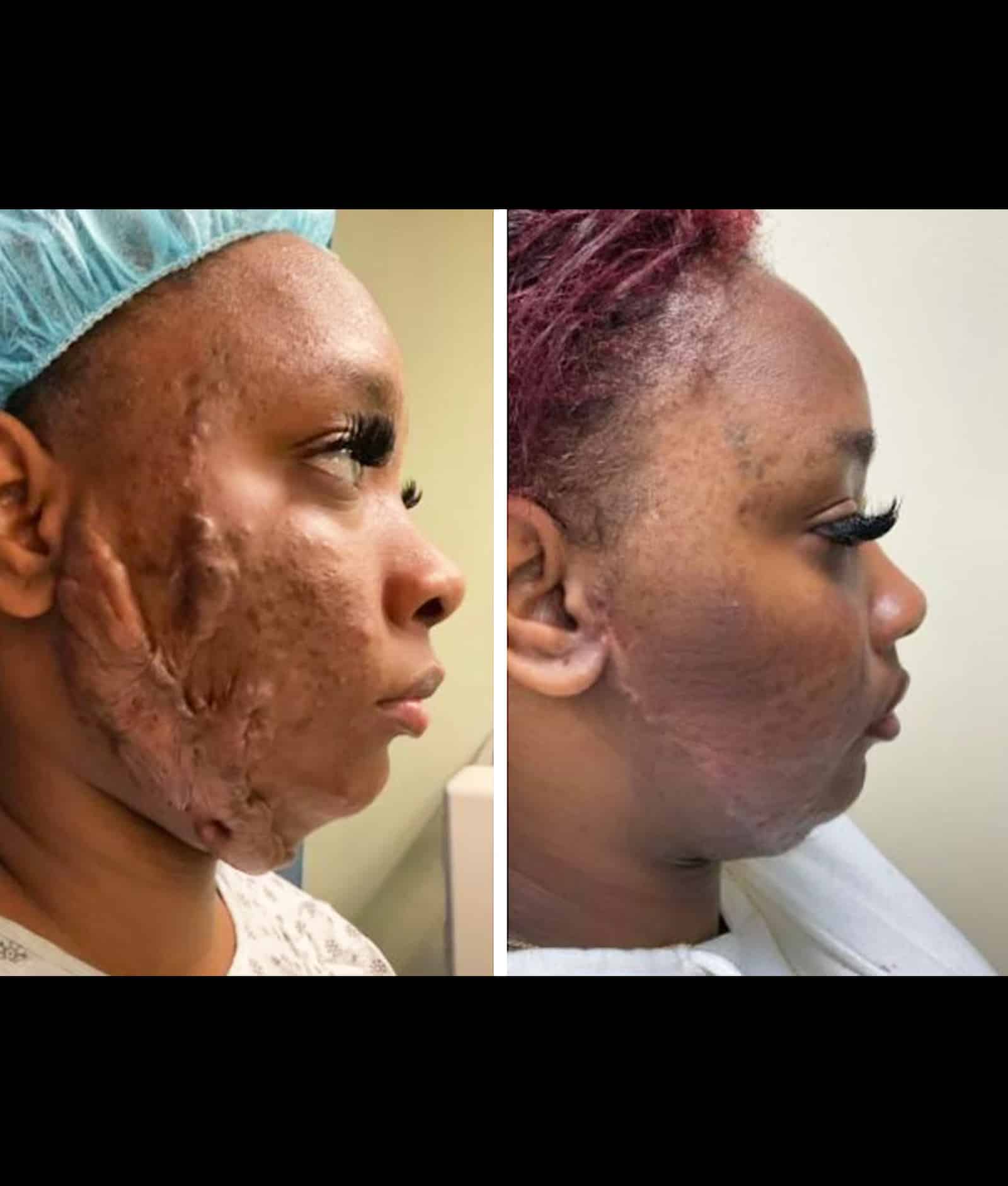 Advanced Scar Treatment Solutions at Wymore Laser