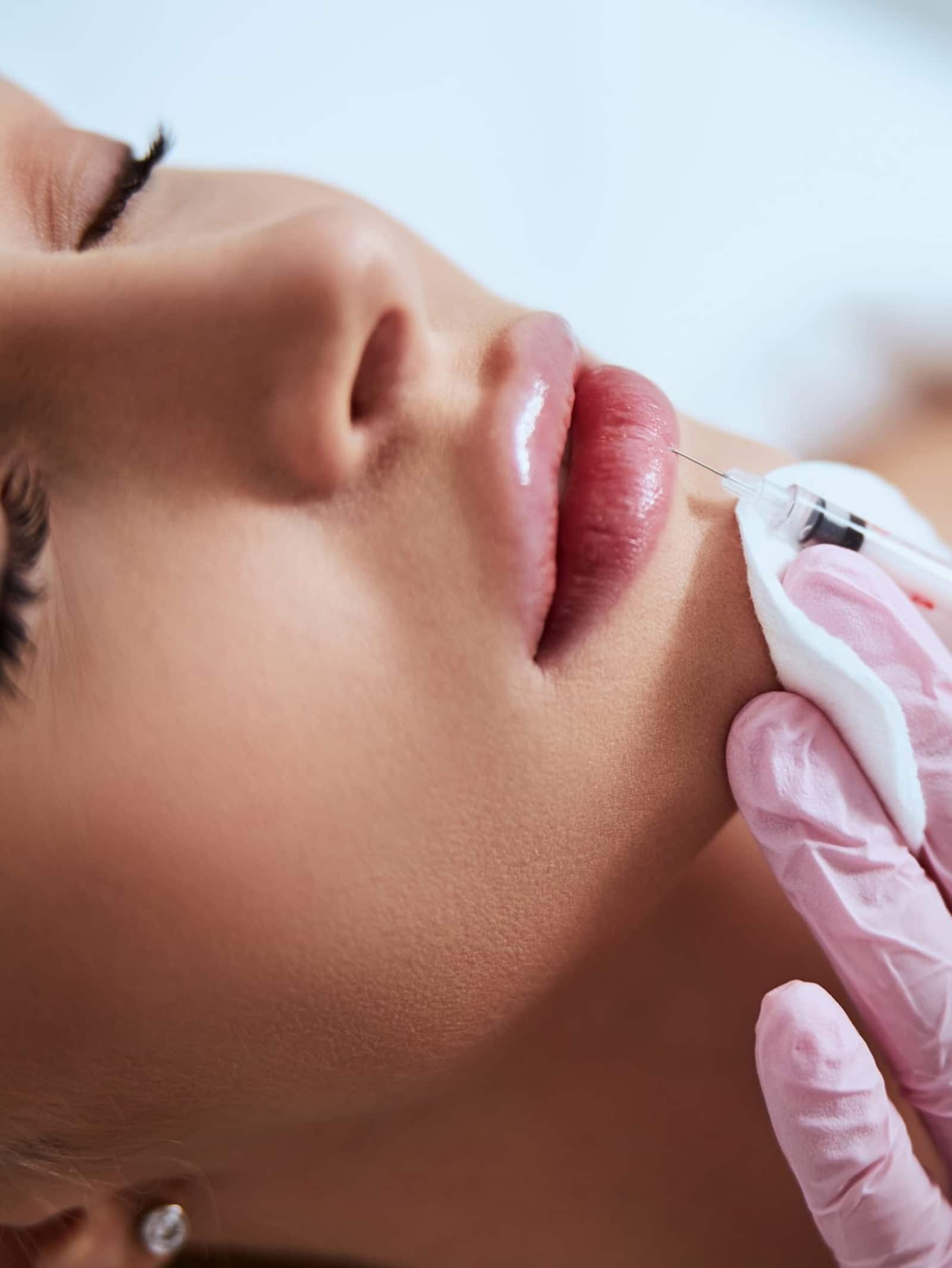 Candidate for Dermal Fillers Candidate for Dermal Fillers